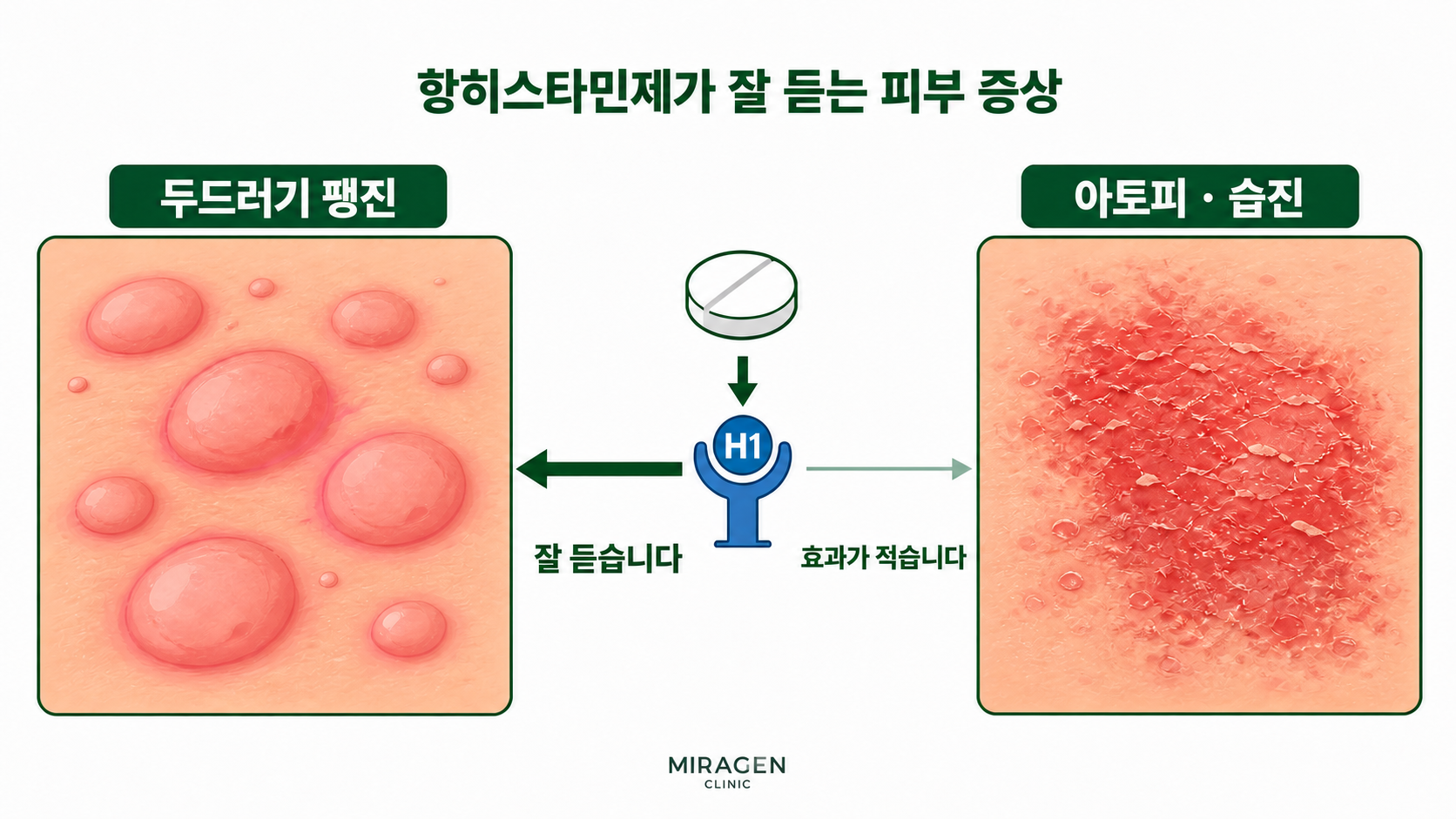 抗ヒスタミン薬・代表画像 抗ヒスタミン薬がじんましんのかゆみにはよく効くものの、アトピーや湿疹のかゆみには効果が薄いという違いを比較した図