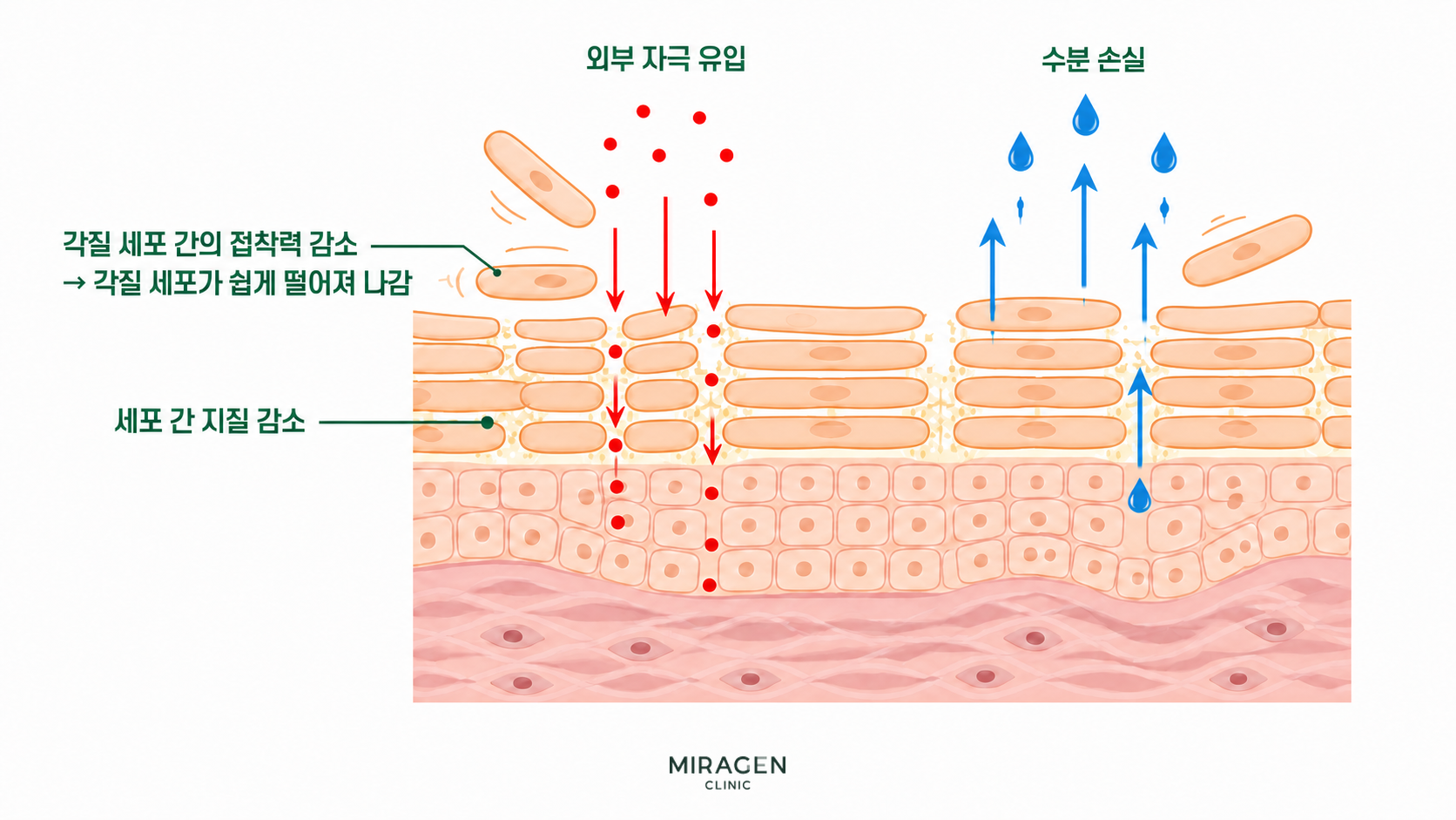 바르는 레티노이드 사용 중 각질 세포 사이의 접착력과 세포 간 지질이 감소해 외부 자극 유입과 수분 손실이 쉬워지는 피부 장벽 변화를 보여주는 그림입니다.