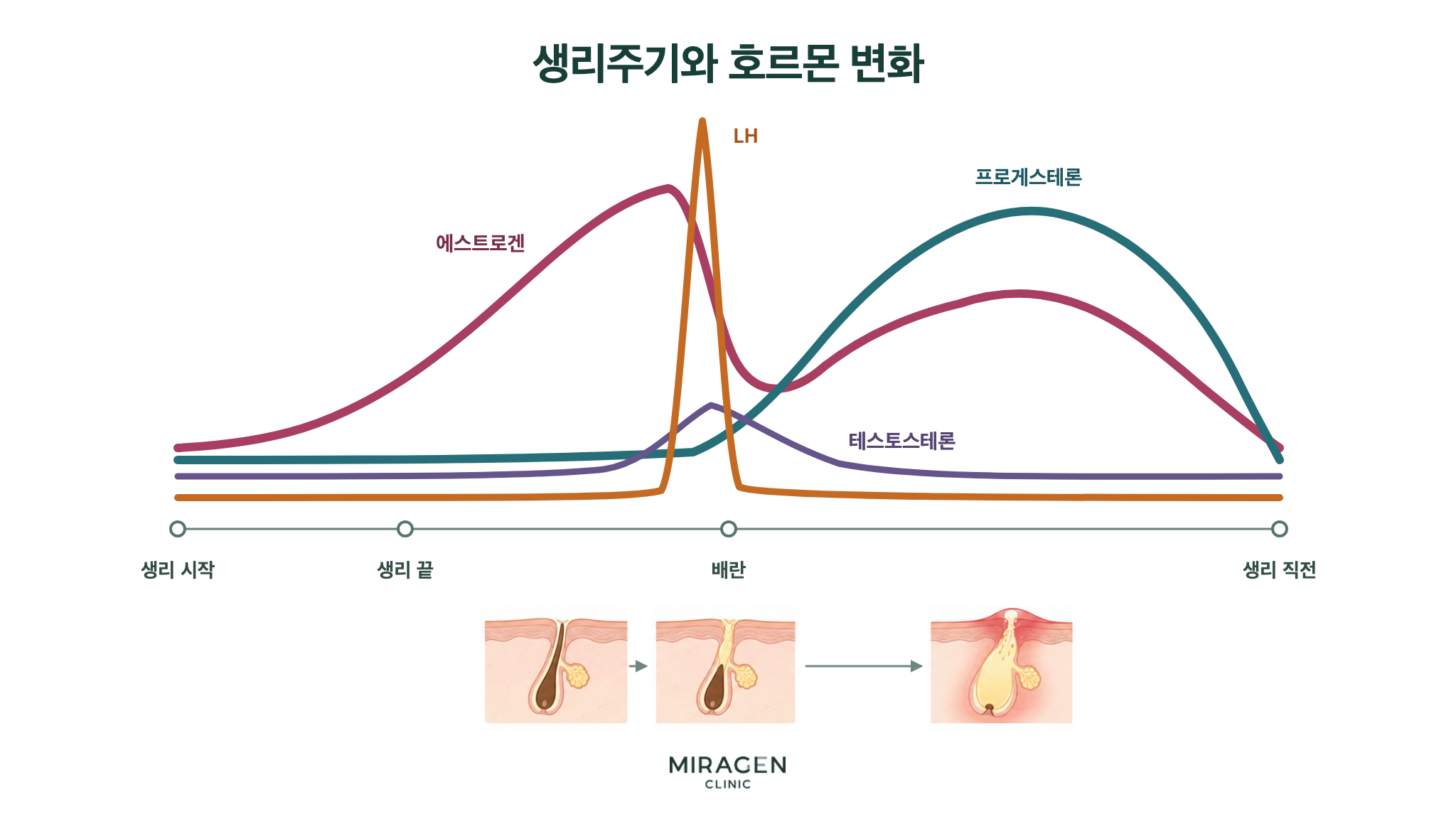 생리 전 여드름 · 본문 이미지 생리주기에 따른 에스트로겐 · 프로게스테론 · LH · 테스토스테론의 변화와 배란 무렵의 모공 막힘이 생리 전 여드름으로 이어질 수 있다는 가설을 표현한 그림