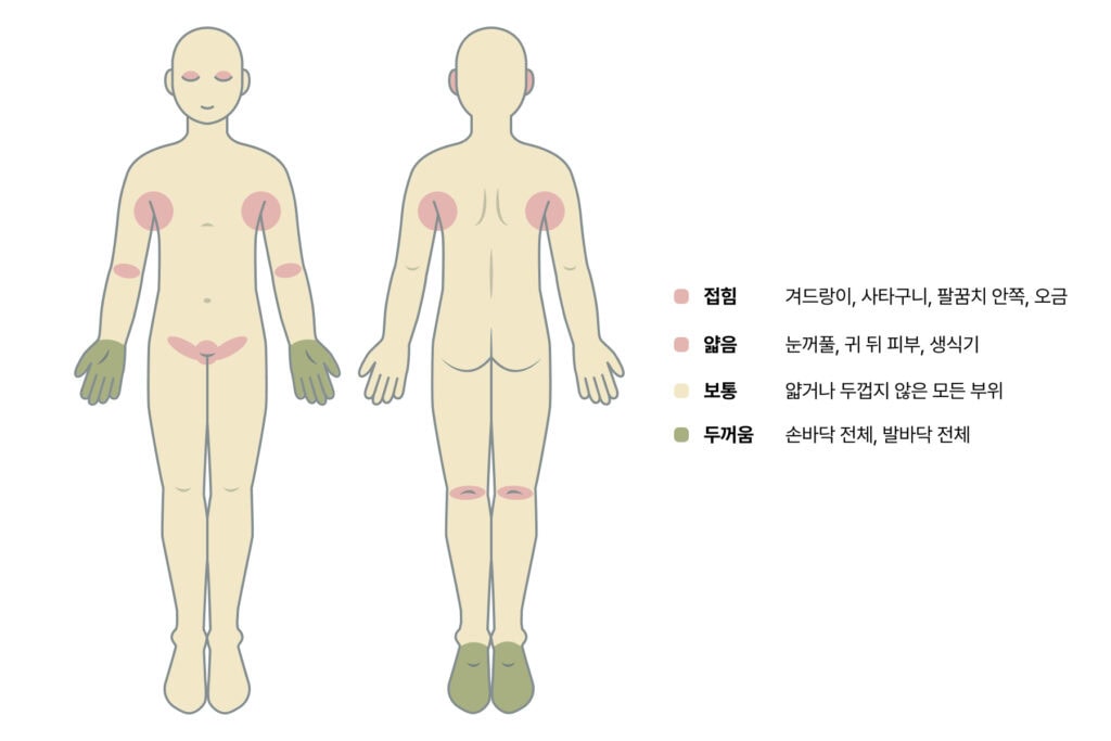 스테로이드 연고 등급 · 본문 이미지 인체 부위별 스테로이드 연고 흡수율 차이를 보여주는 인포그래픽으로, 눈꺼풀과 생식기는 흡수율이 높고 손바닥과 발바닥은 낮아 부위에 따라 연고 등급을 달리 선택해야 함을 설명
