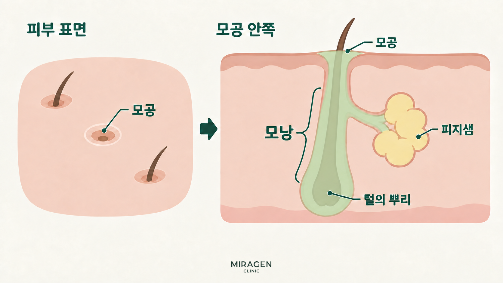 왼쪽은 피부 표면의 모공, 오른쪽은 모공 아래로 이어지는 모낭과 옆으로 연결된 피지샘 및 아래쪽 털뿌리를 보여주는 단면도