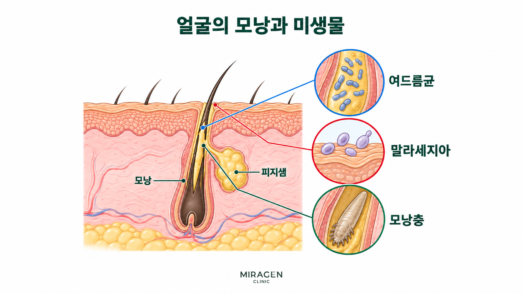 스테로이드 연고 부작용 · 본문 이미지 얼굴 피부의 모낭과 피지샘 구조, 여드름균과 말라세지아 및 모낭충의 모습을 확대해 보여주는 모식도