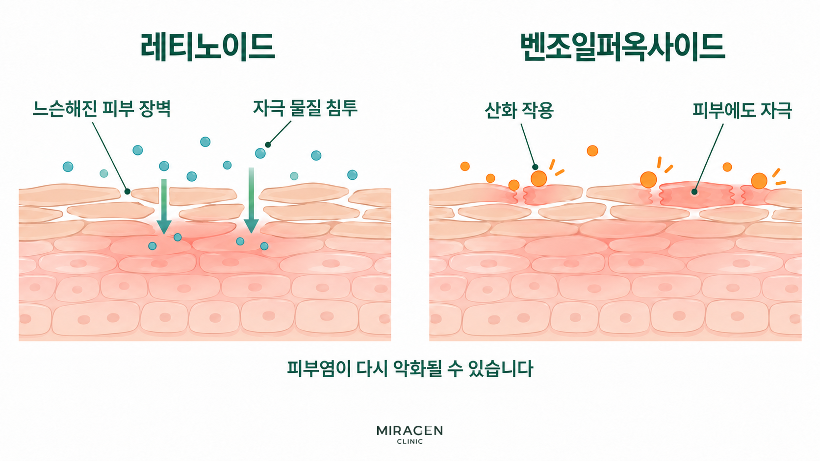 윈레비 크림 후기 · 본문 이미지 레티노이드로 피부 장벽이 느슨해져 자극 물질이 들어오는 과정과 벤조일퍼옥사이드의 산화 작용이 피부에도 자극을 주는 과정을 나란히 보여주는 피부 단면 그림
