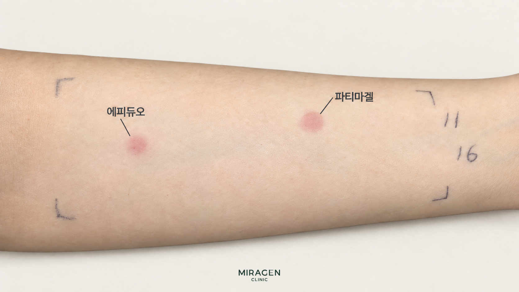 팔의 에피듀오겔과 파티마겔 도포 부위에 나타난 붉은 피부 반응을 표시한 편집 이미지