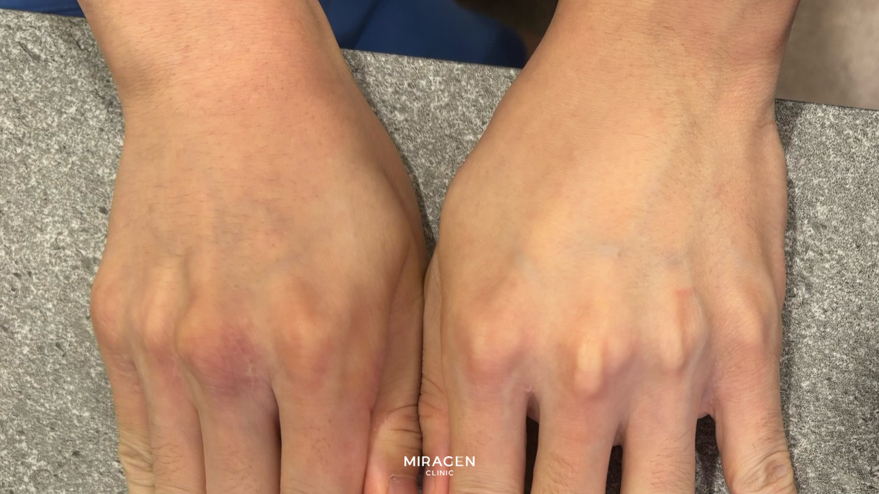 윈레비 크림 후기 · 본문 이미지 윈레비 크림 후기: 크림을 바른 오른쪽 손과 바르지 않은 왼쪽 손 비교