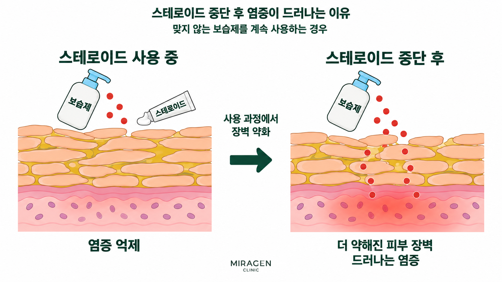 스테로이드 연고 부작용 · 본문 이미지 맞지 않는 보습제를 계속 사용할 때 스테로이드 사용 중 억제된 염증과 장벽이 더 약해진 상태에서 중단 후 드러나는 염증을 비교한 모식도