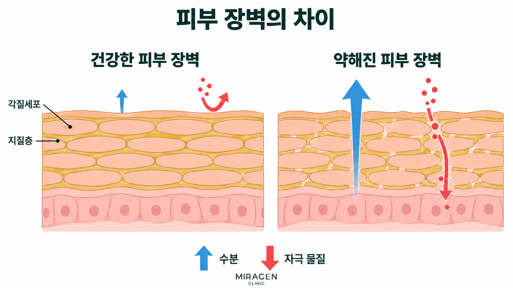 스테로이드 연고 부작용 · 본문 이미지 스테로이드 연고 부작용인 피부 장벽 약화를 설명하는 그림. 건강한 피부와 약해진 피부의 각질세포 · 지질층 · 수분 손실 · 자극 물질 침투 비교