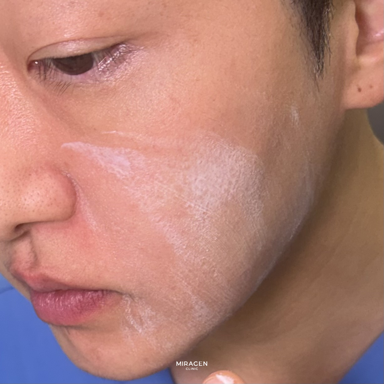윈레비 크림 후기 · 본문 이미지 얼굴에 윈레비 크림을 펴 바르는 동안 하얗게 보이는 모습