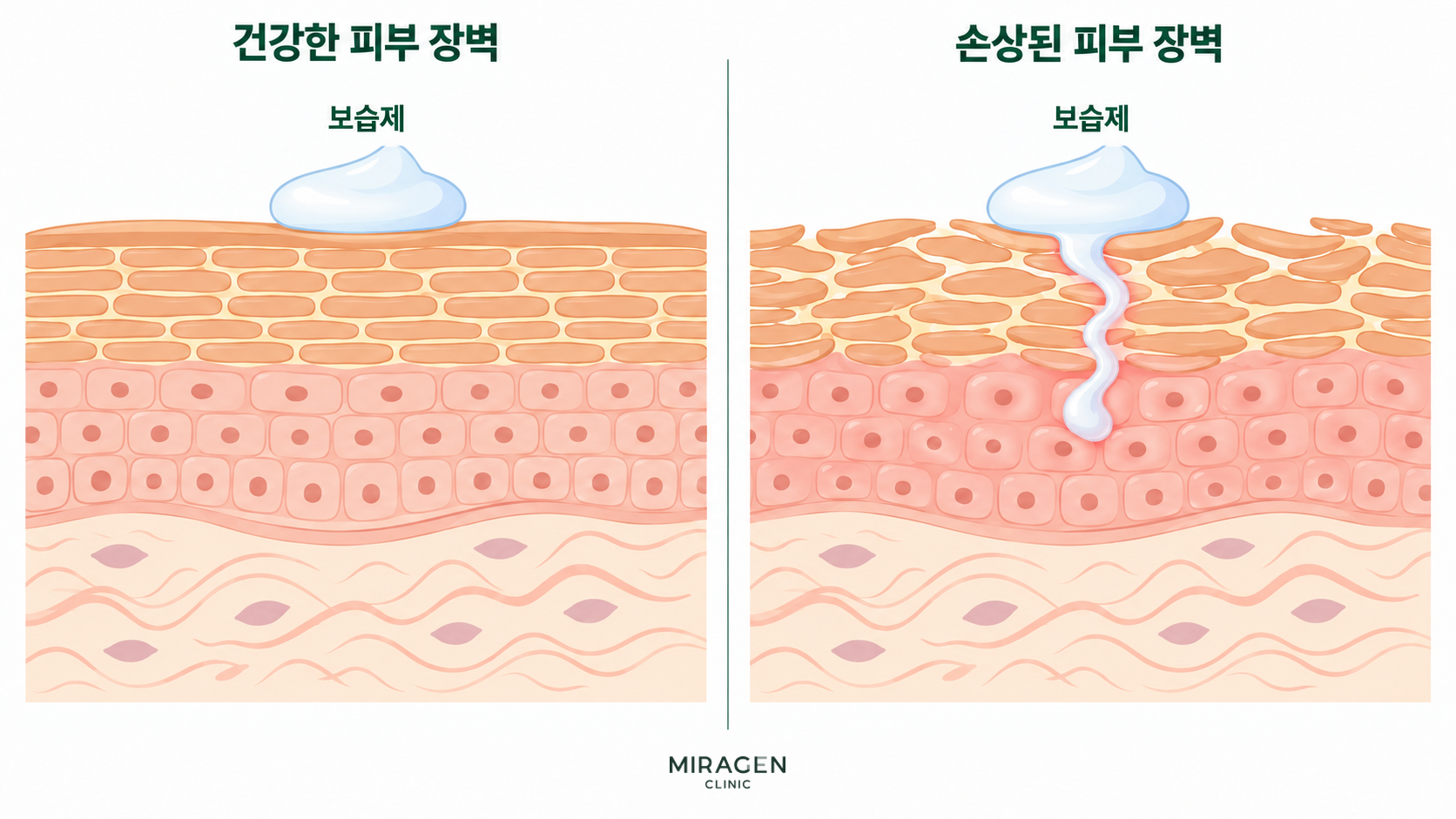 스테로이드 연고 등급 · 본문 이미지 건강한 피부 장벽에서는 보습제가 표면에 머물고, 손상된 피부 장벽에서는 보습제 일부가 피부 안쪽으로 스며드는 모습을 비교한 그림