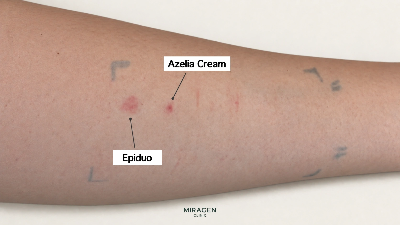ภาพแก้ไขจากผลทดสอบแผ่นแปะ แสดงรอยแดงตรงตำแหน่งยาทารักษาสิว Azelia Cream และ Epiduo Gel