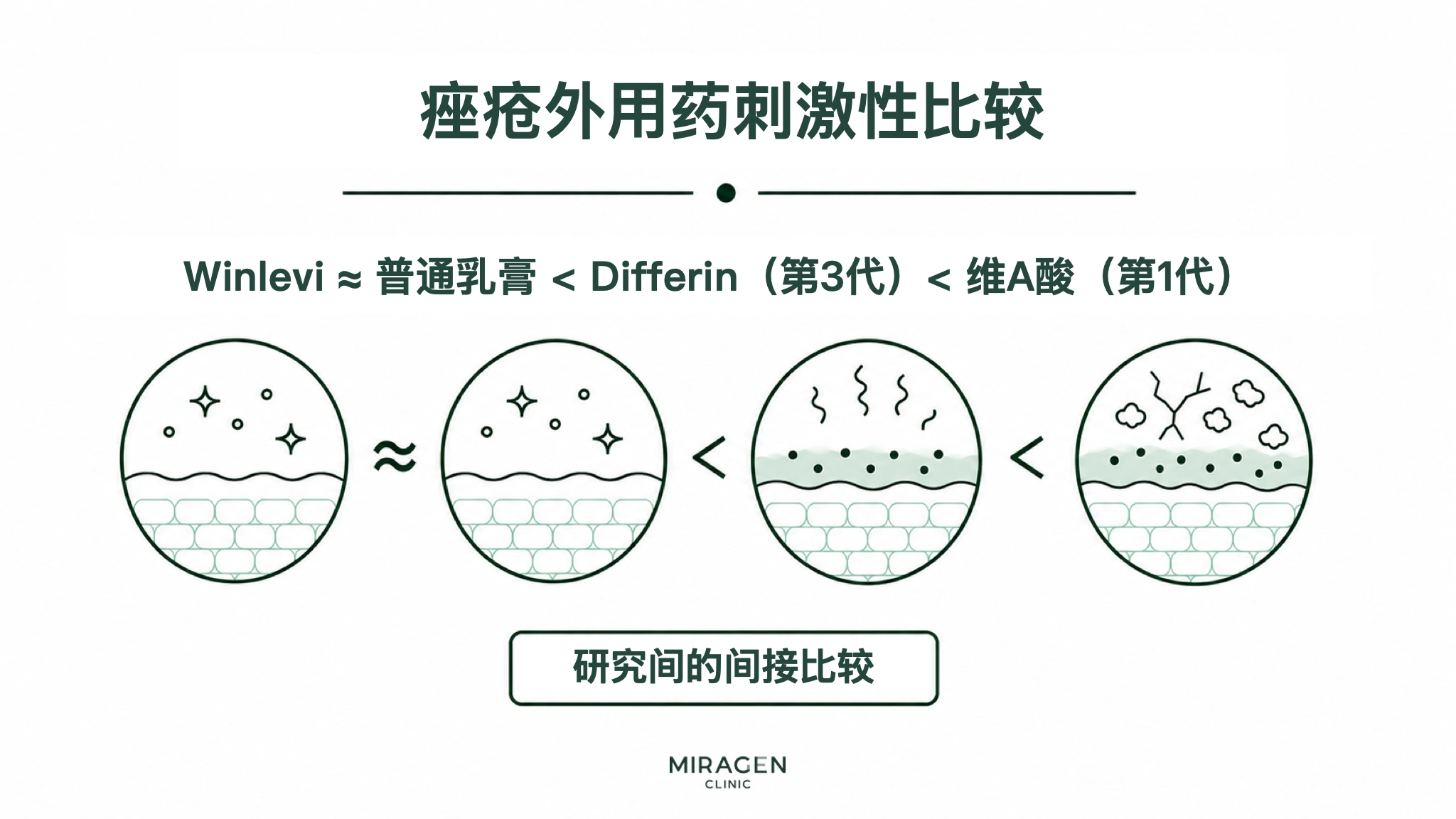 痤疮外用药信息图，用一条顺序线和四幅皮肤剖面图，比较 Winlevi 乳膏、普通乳膏、第三代达芙文凝胶及第一代维A酸凝胶的皮肤刺激程度