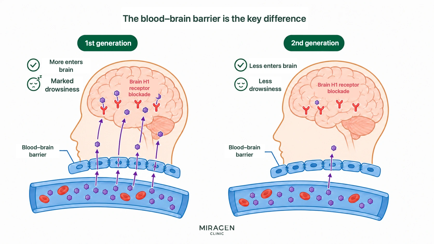 Illustration showing that first-generation antihistamines like Peniramin Tablets cross the blood–brain barrier more readily, block brain H1 receptors, and cause marked drowsiness, whereas second-generation agents enter the brain less and cause less drowsiness