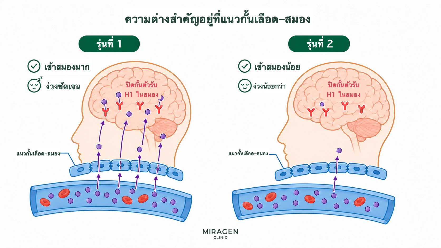ภาพเปรียบเทียบยาต้านฮิสตามีนรุ่นที่ 1 ที่ผ่านแนวกั้นเลือดกับสมองมากและปิดกั้นตัวรับ H1 ในสมองจนง่วง กับรุ่นที่ 2 ที่เข้าสมองน้อยและง่วงน้อยกว่า