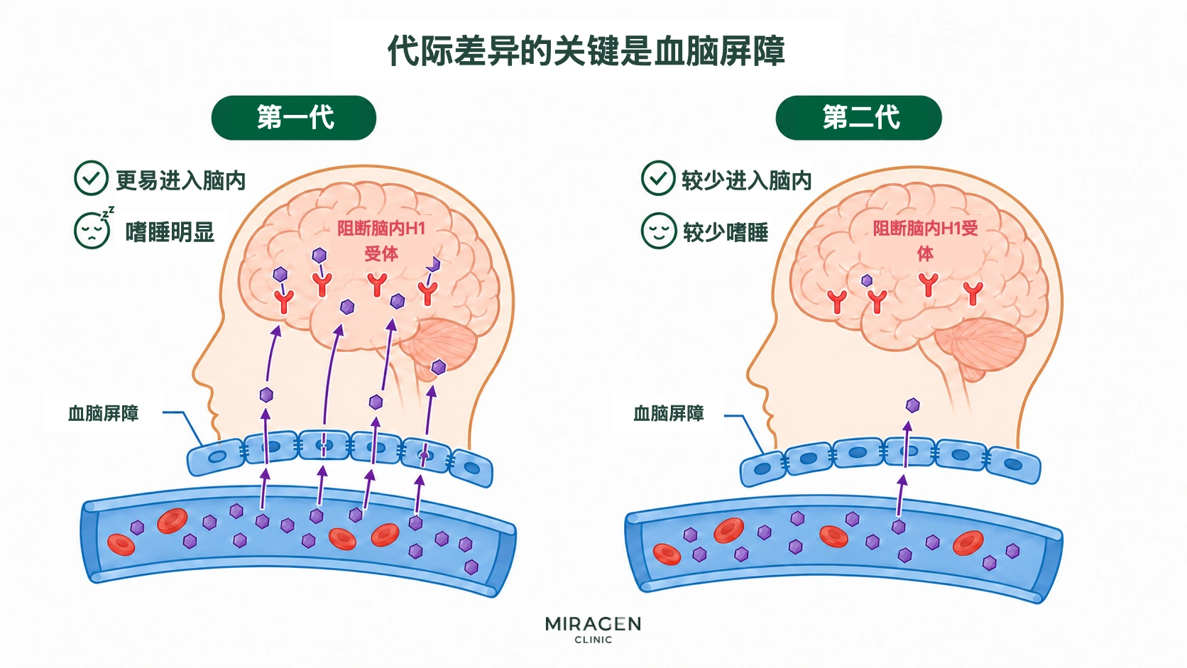 对比图：第一代抗组胺药较多穿过血脑屏障，困倦明显；艾来片等第二代药物进入大脑的量较少