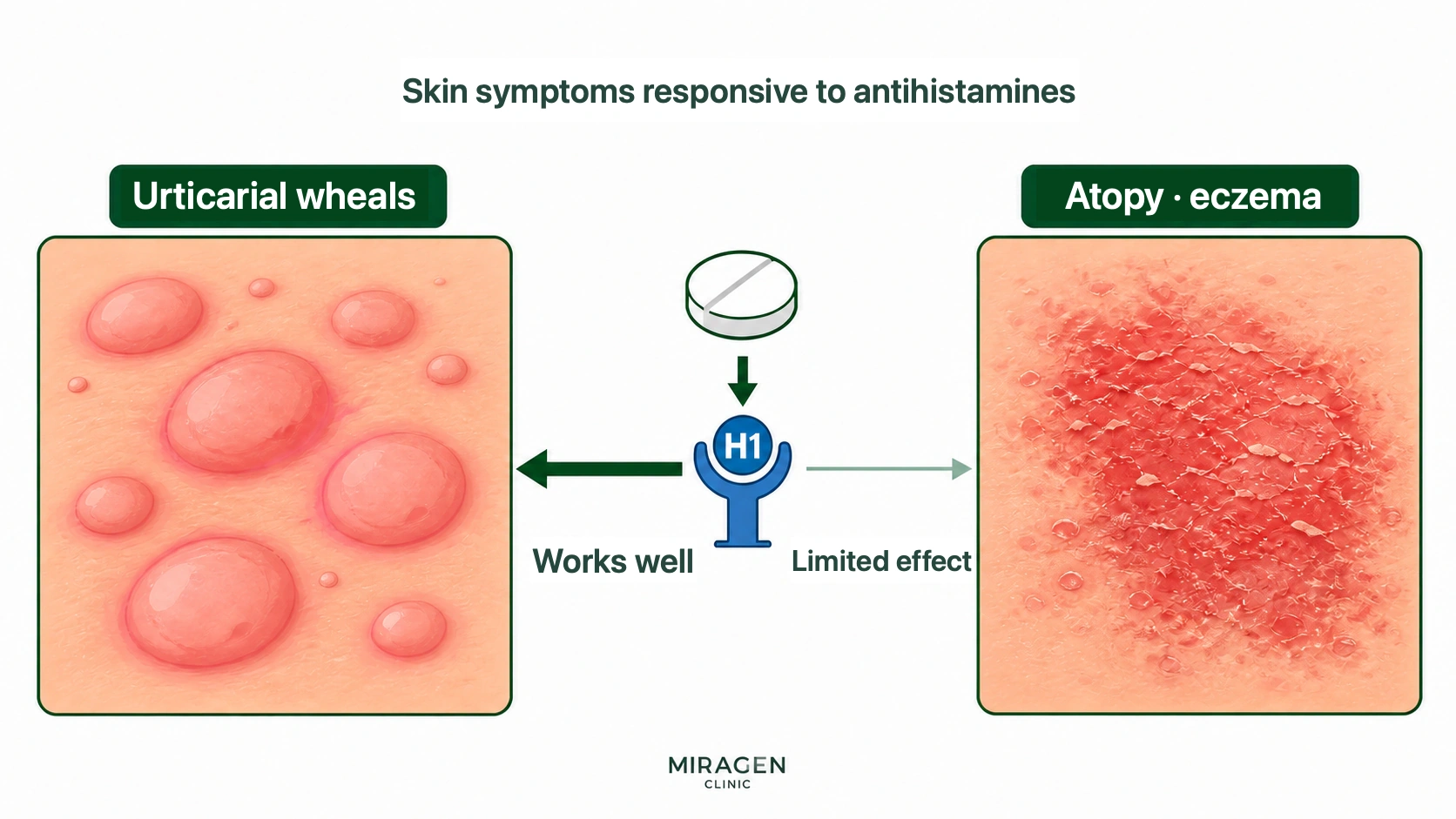 An illustration comparing how antihistamines work well for hives but are less effective for itching caused by atopic dermatitis and eczema