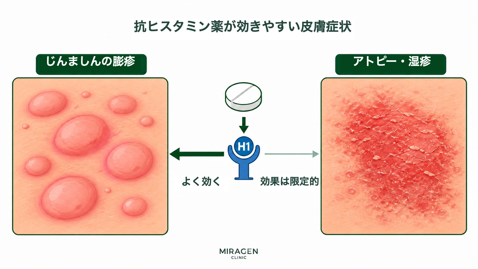 抗ヒスタミン薬がじんましんのかゆみにはよく効くものの、アトピーや湿疹のかゆみには効果が薄いという違いを比較した図
