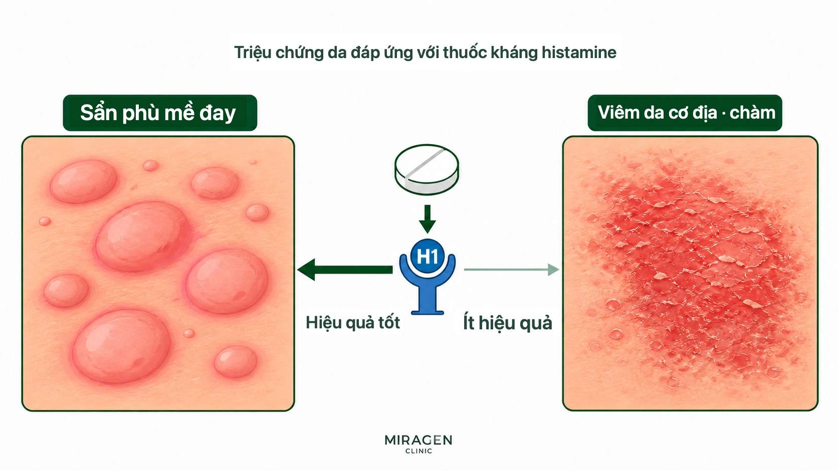 So sánh hiệu quả của thuốc kháng histamin đối với ngứa do mề đay và hiệu quả thấp đối với ngứa do viêm da cơ địa hoặc chàm