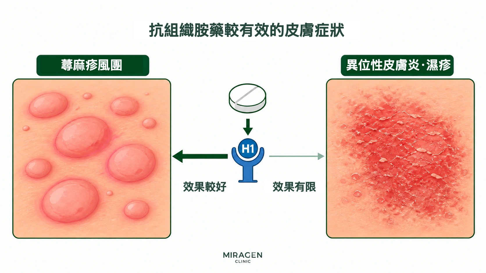 對比圖:抗組織胺藥對蕁麻疹的搔癢效果較好,對異位性皮膚炎和濕疹的搔癢作用較小