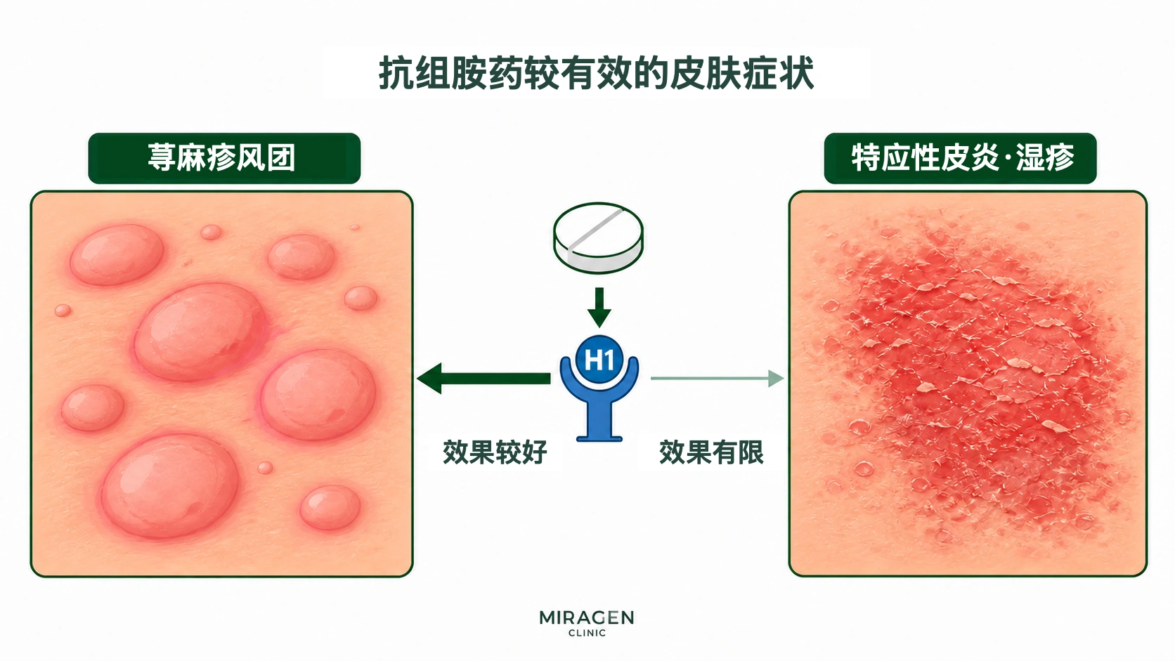 对比图：抗组胺药对荨麻疹的瘙痒效果较好，对特应性皮炎和湿疹的瘙痒作用较小