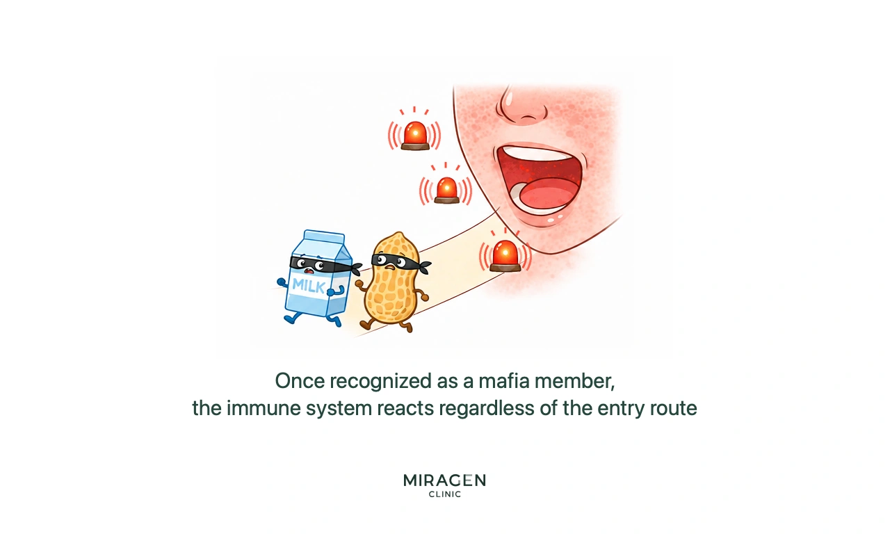 An illustration depicting milk and peanuts, once recognized as the Mafia, entering through the mouth wearing burglar masks and triggering an immune alarm; it explains the process of how food allergies spread systemically after skin barrier damage.