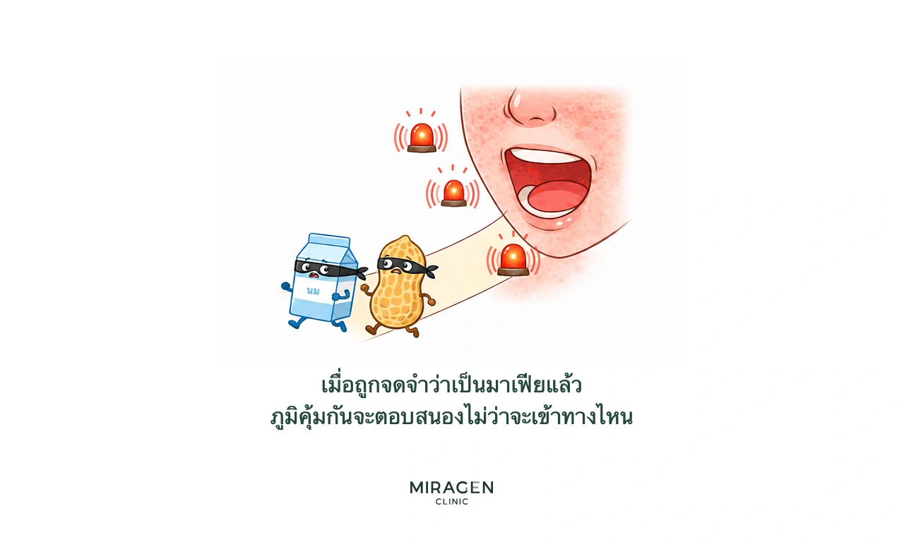 ภาพนมและถั่วลิสงที่ถูกมองว่าเป็นมาเฟียสวมหน้ากากโจรแล้วเข้าทางปาก กระตุ้นสัญญาณภูมิคุ้มกัน แสดงการแพ้อาหารทั่วร่างกายหลังเกราะป้องกันผิวเสียหาย