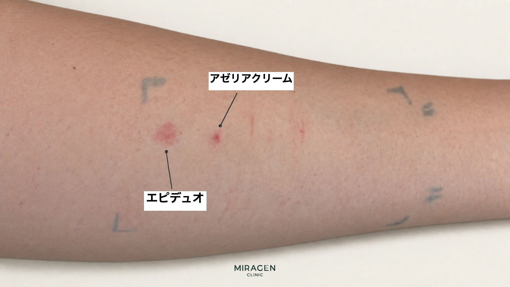 腕のアゼリアクリームとエピデュオゲル塗布部位に現れた赤い皮膚反応を示した編集画像