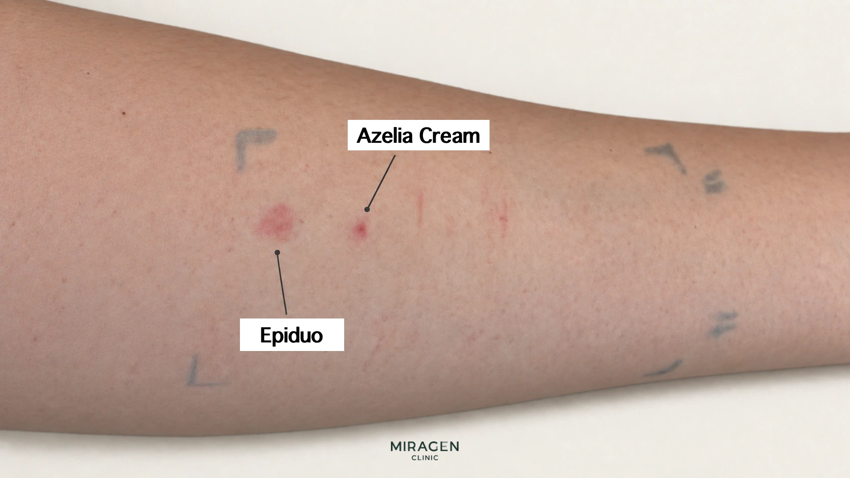 ภาพแก้ไขแสดงผิวแดงบนแขนจากการทดสอบแผ่นแปะด้วยยาทาสิว Azelia Cream และ Epiduo Gel