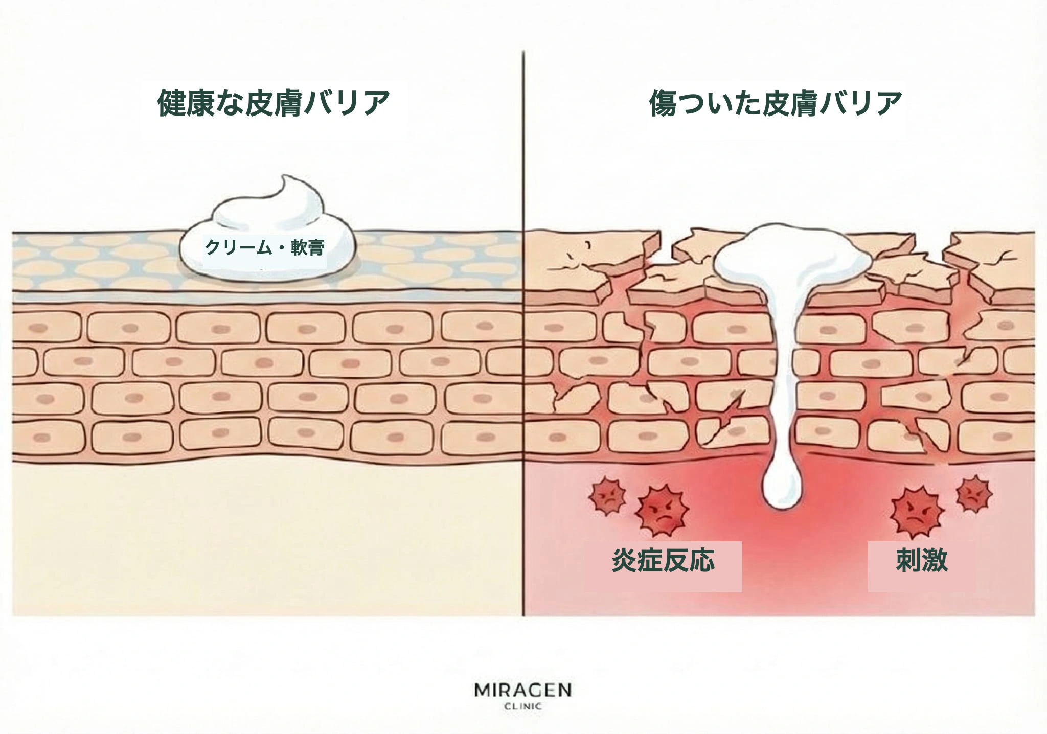 エリデル使用時における、健康な皮膚バリアと損傷した皮膚バリアでの外用剤の浸透と刺激反応の違いを比較した皮膚断面イラスト