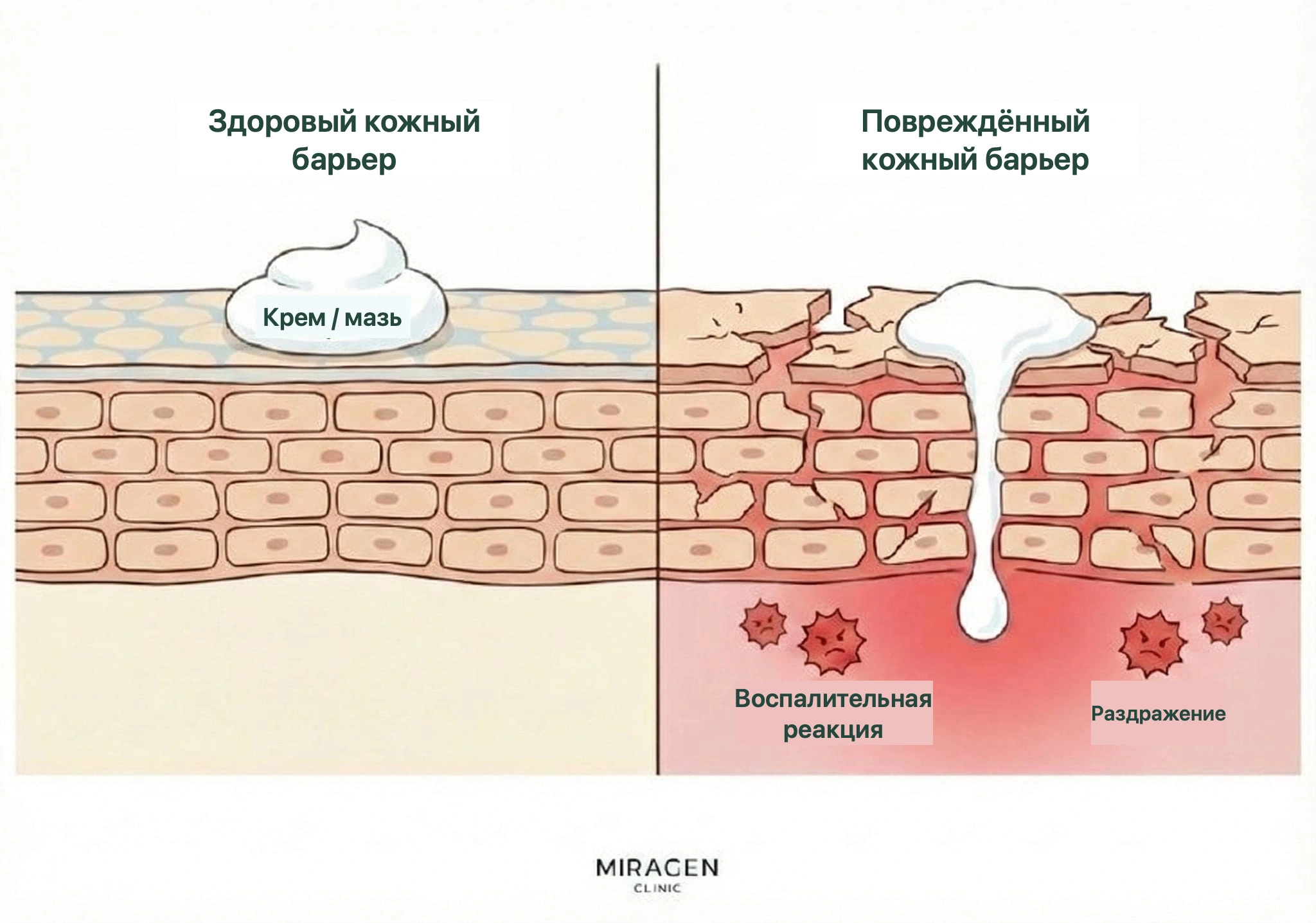 Разрез кожи сравнивает проникновение местного препарата и раздражающую реакцию при здоровом и поврежденном кожном барьере