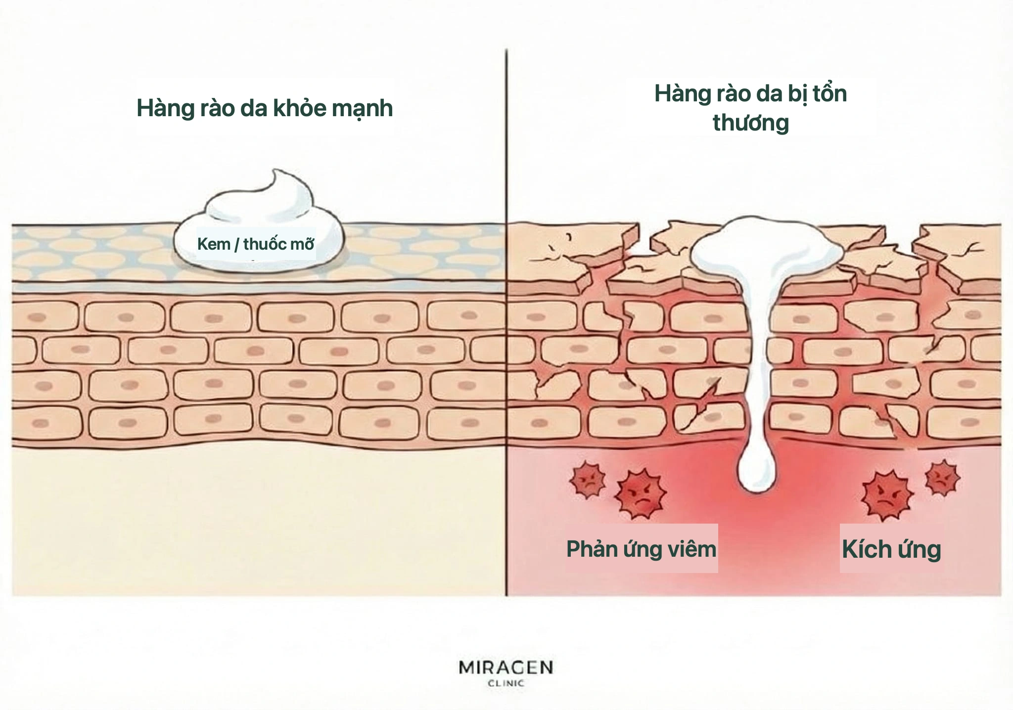 Minh họa mặt cắt da so sánh mức thấm của thuốc bôi và phản ứng kích ứng khi hàng rào da khỏe hoặc tổn thương