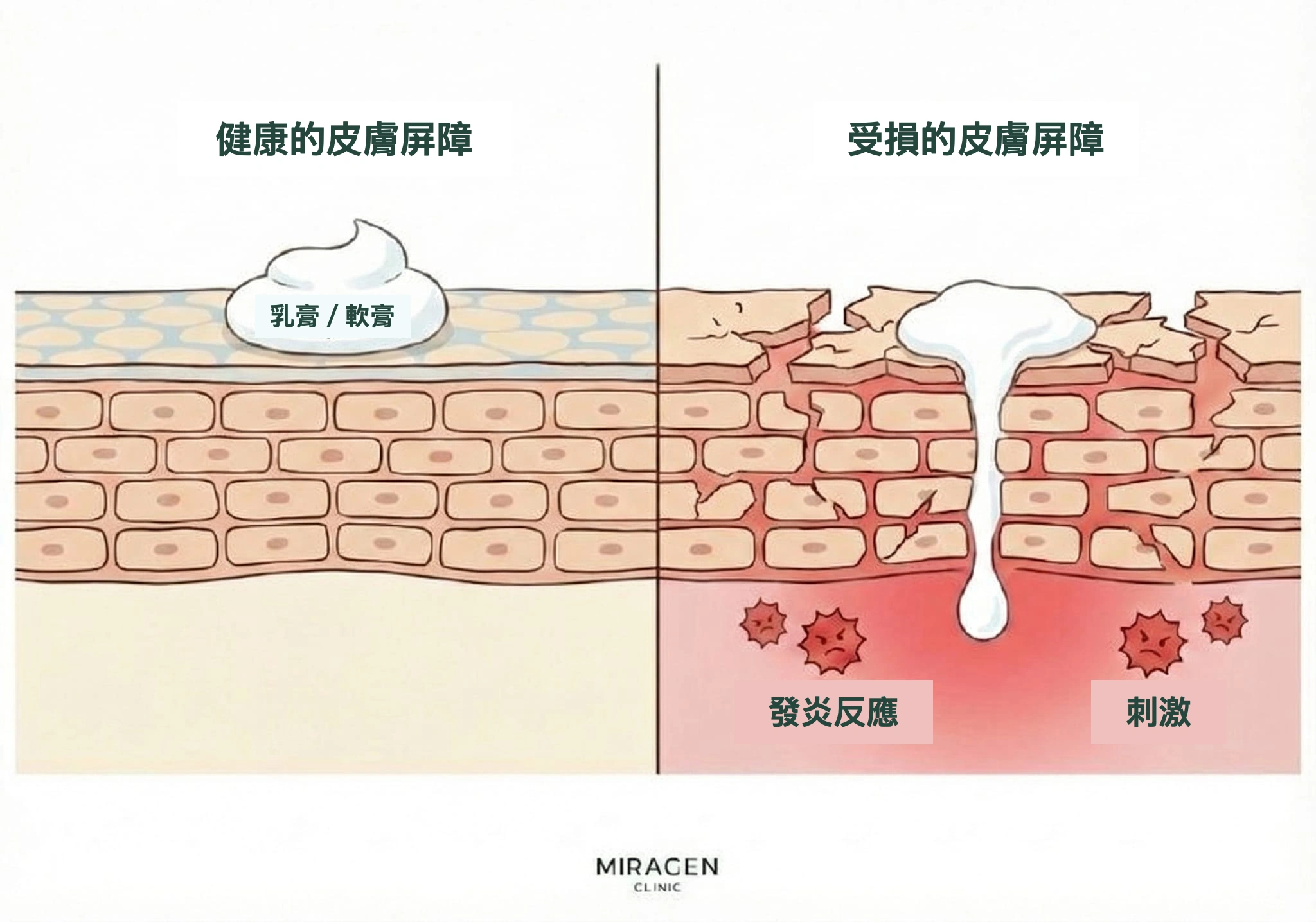皮膚剖面插圖比較使用Elidel時，健康與受損皮膚屏障中外用藥滲透程度及刺激反應的差別