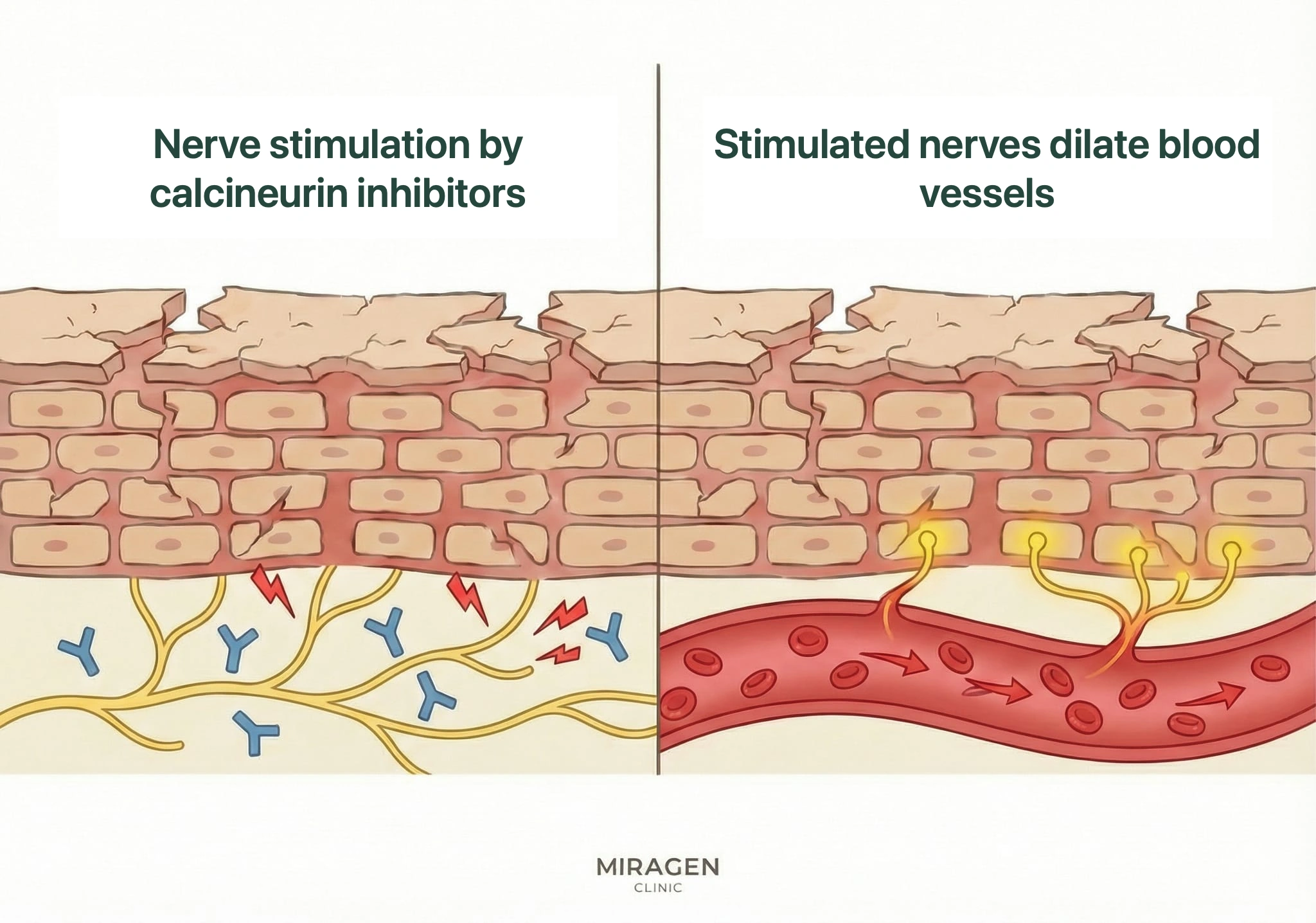 A cross-sectional skin illustration showing the process in which early burning occurs due to nerve stimulation and vasodilation after applying a calcineurin inhibitor like Elidel