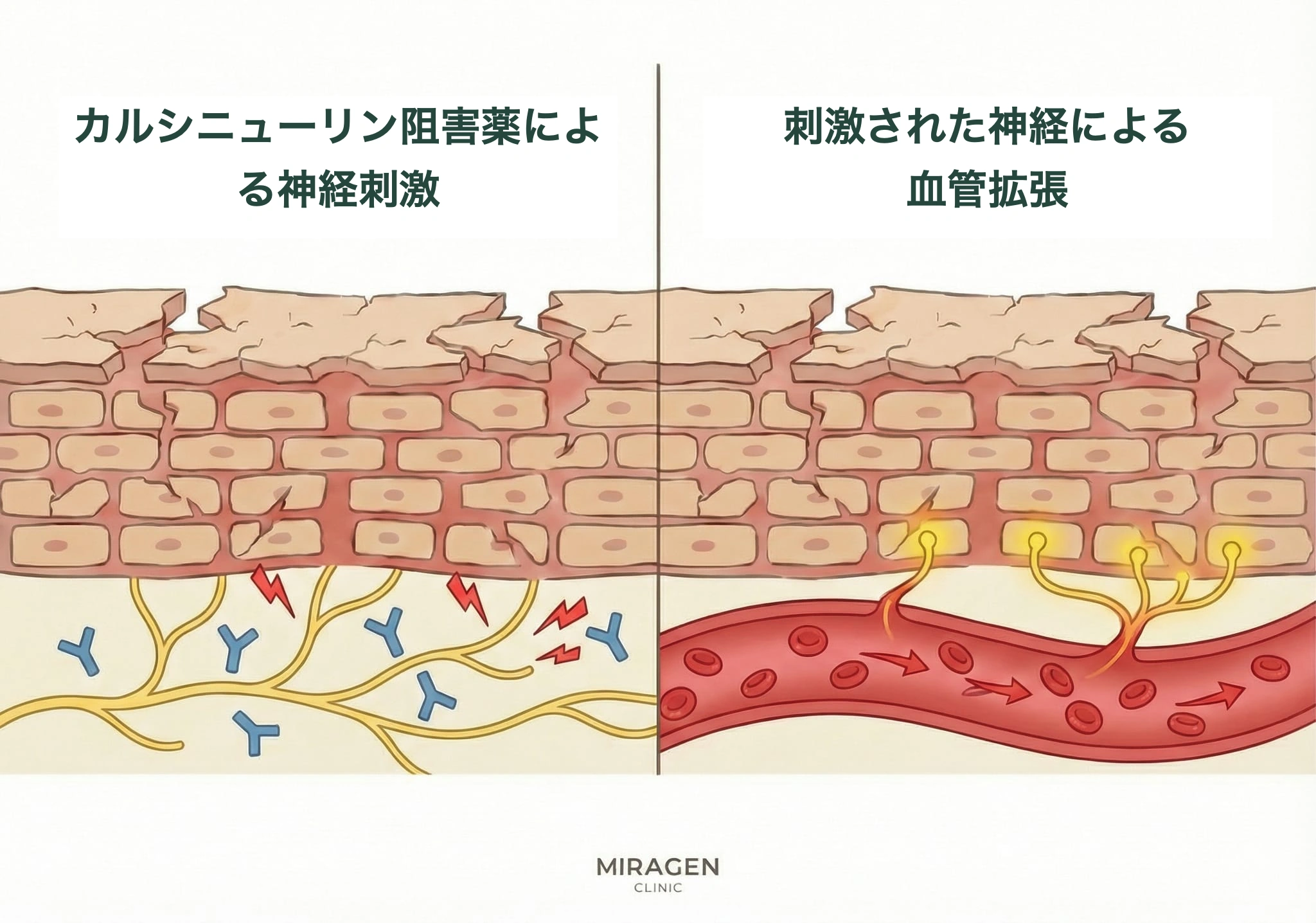 エリデルのようなカルシニューリン阻害薬の塗布後、神経刺激と血管拡張によって初期のほてりが生じるプロセスを示した皮膚断面イラスト