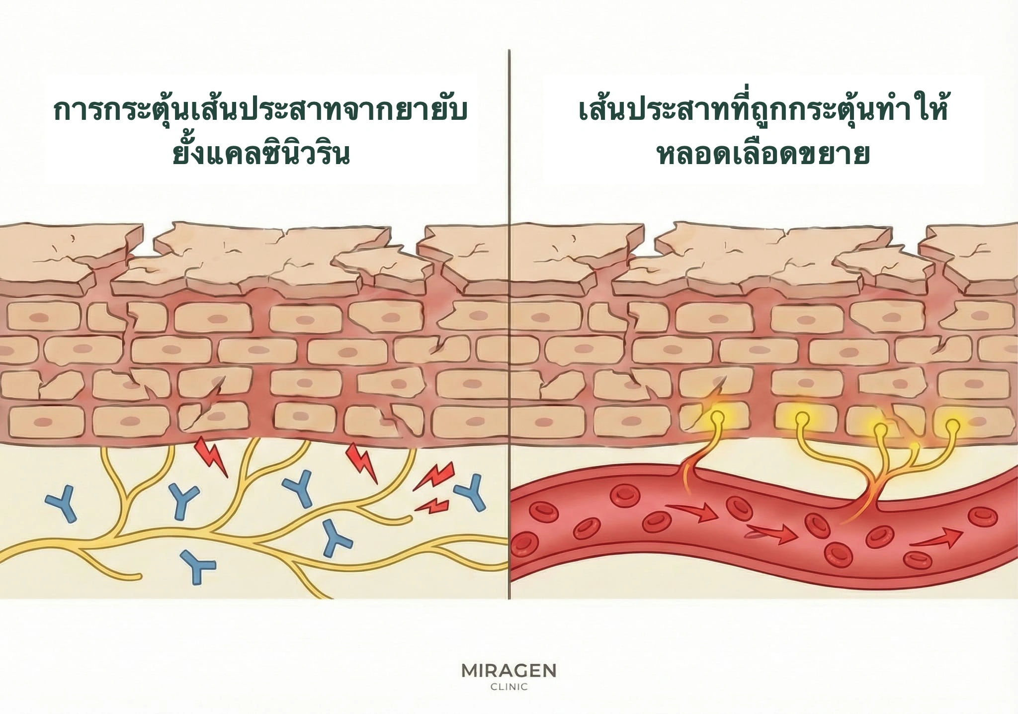 ภาพกลไกการระคายเคืองช่วงแรกของเอลิเดล โดยการกระตุ้น TRPV1 ทำให้ปล่อย Substance P และ CGRP เกิดร้อนแสบและหน้าแดง