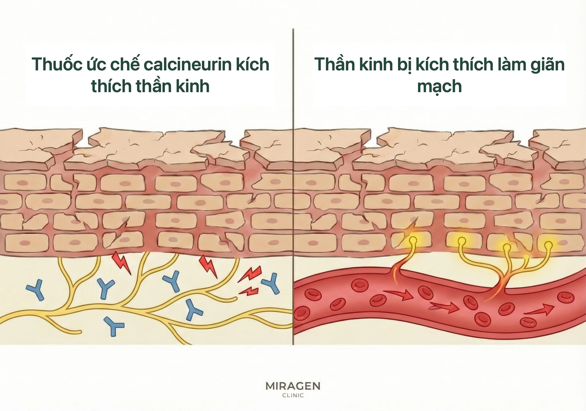 Minh họa cơ chế nóng rát ban đầu khi dùng Elidel hoặc Protopic do kích thích thụ thể TRPV1