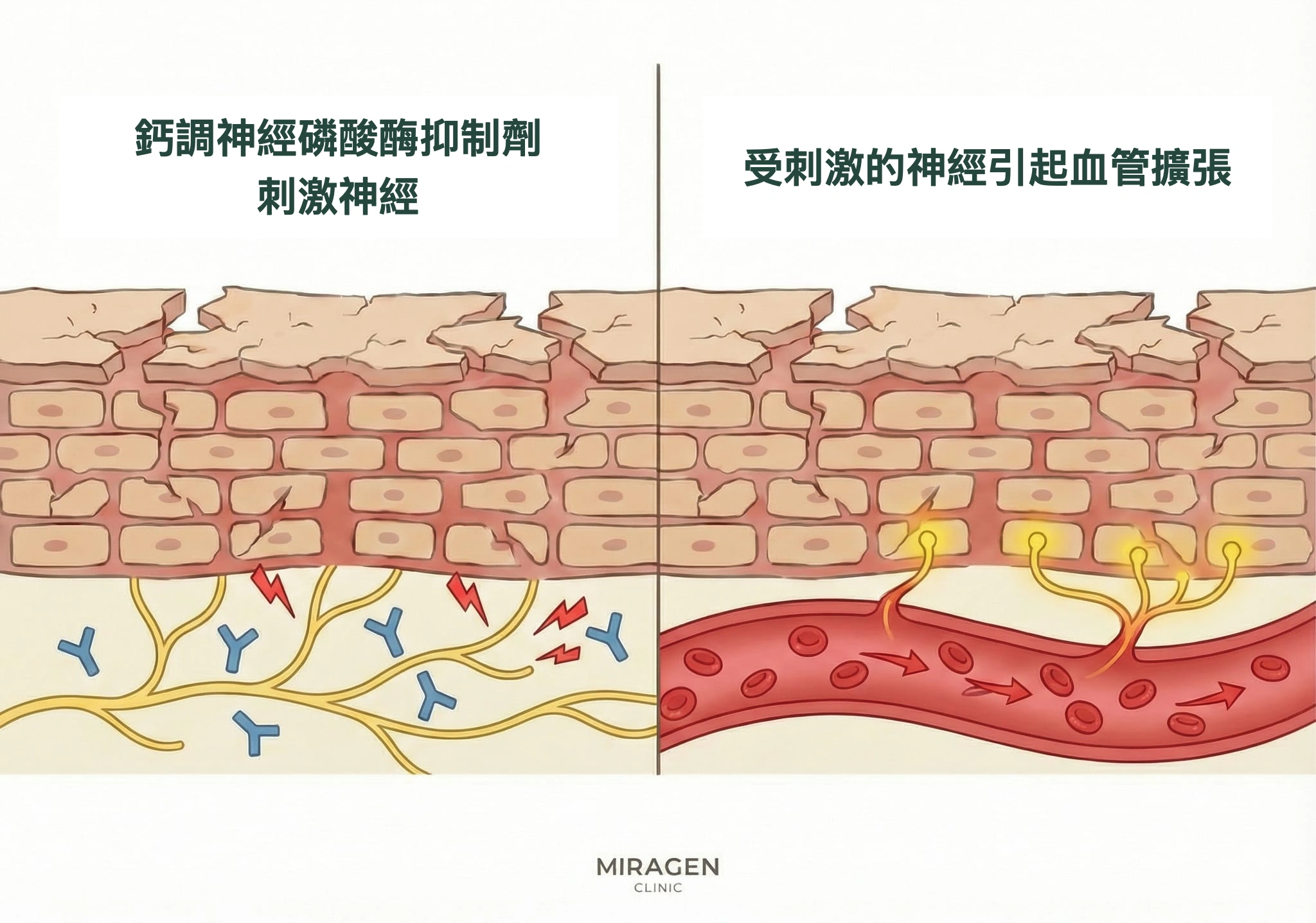 皮膚剖面插圖展示塗Elidel等鈣調神經磷酸酶抑制劑後，神經受刺激、血管擴張，產生初期灼熱感的過程