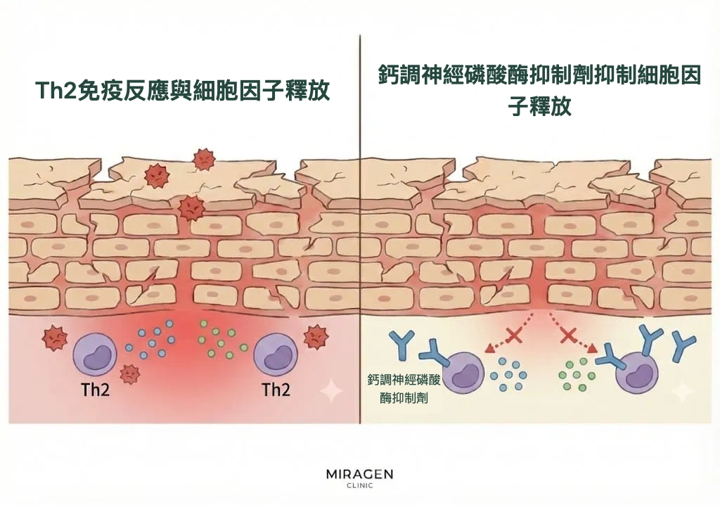 插圖展示Elidel等鈣調神經磷酸酶抑制劑阻斷 T 細胞的 Th2 免疫反應、減輕發炎的原理