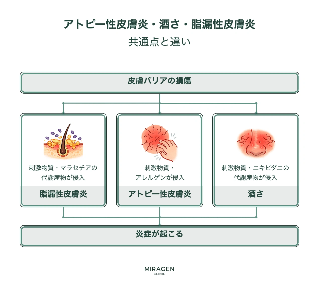 アトピー・酒さ皮膚炎・脂漏性皮膚炎を比較するインフォグラフィックで、三疾患すべて皮膚バリア損傷から始まるが、アトピーはアレルゲン、酒さ皮膚炎はニキビダニ、脂漏性皮膚炎はマラセチアが主な悪化因子である違いを示す