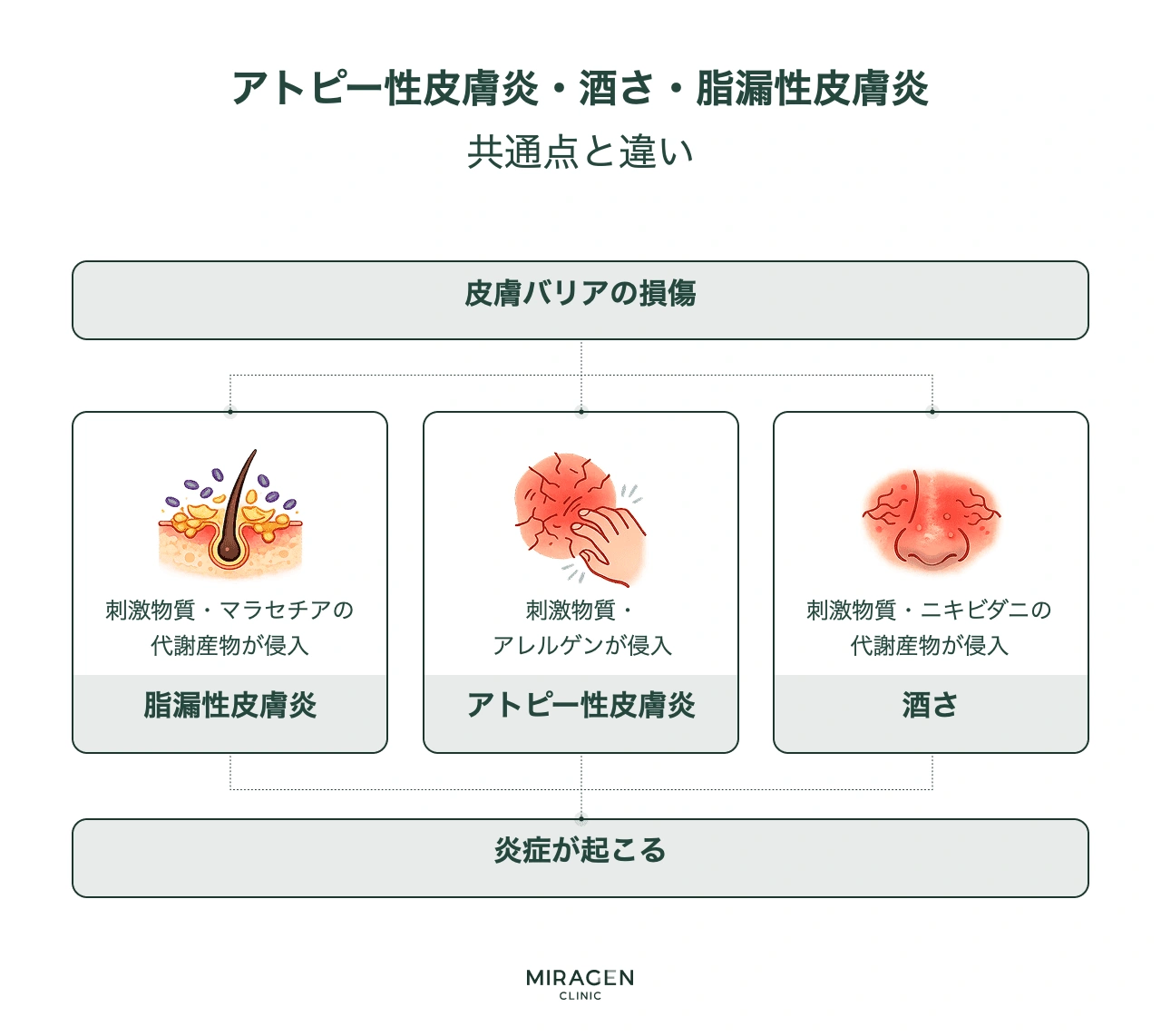 酒さ・アトピー・脂漏性皮膚炎の比較インフォグラフィックで、3つの疾患すべてが皮膚バリアの損傷から始まりますが、酒さは毛包虫の代謝産物、アトピーはアレルゲン、脂漏性皮膚炎はマラセチアが浸透するという違いを示しています。