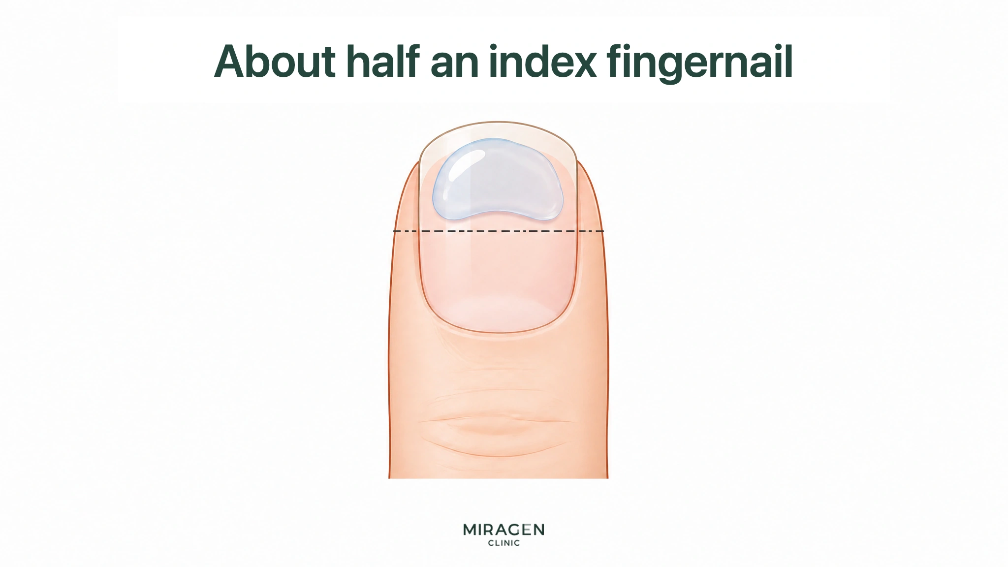 An illustration showing the starting dose when mixing Differin Gel with moisturizer, with a transparent gel placed on the upper half of the index fingernail and a dotted line indicating the measurement standard.