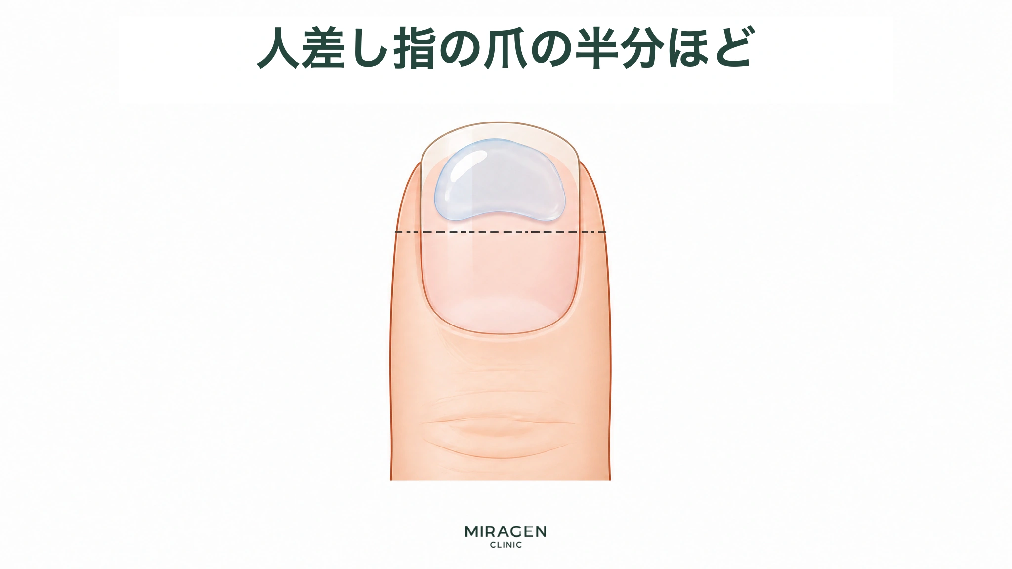 人差し指の爪の上半分に相当する量の透明なゲルを載せ、点線で使用量の基準を示し、ディフェリンゲルを保湿剤と混ぜる際の開始用量を示す図です。