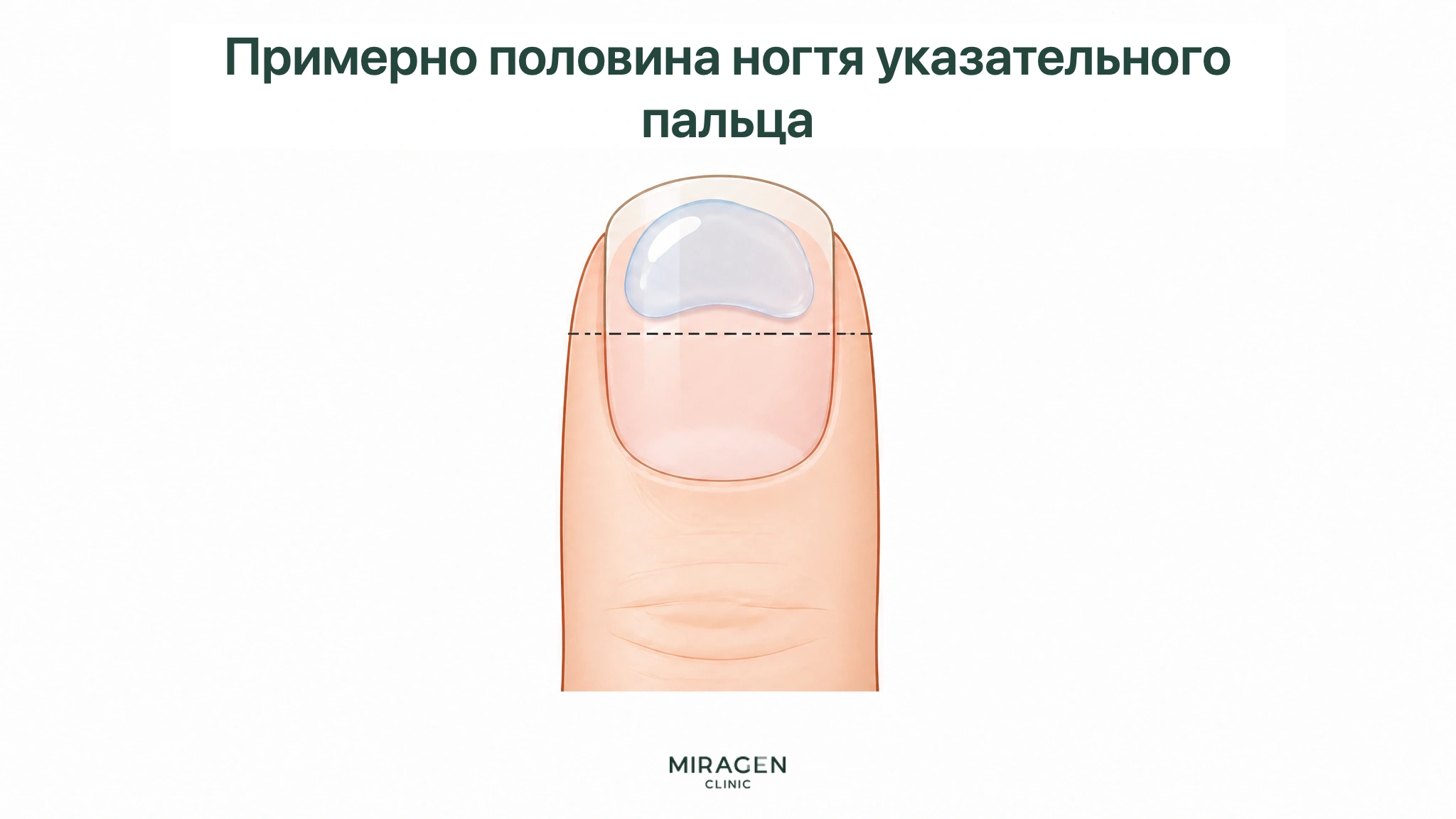 На указательном пальце показано начальное количество прозрачного Дифферина размером с половину ногтя для смешивания с увлажняющим кремом