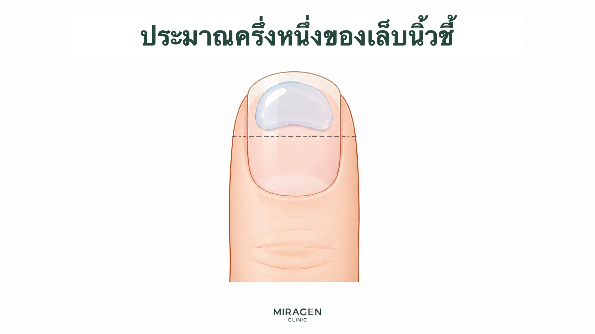 ภาพเจลใสบนครึ่งบนของเล็บนิ้วชี้ มีเส้นประบอกปริมาณเริ่มต้นของดิฟเฟอรินเจลสำหรับผสมมอยส์เจอไรเซอร์