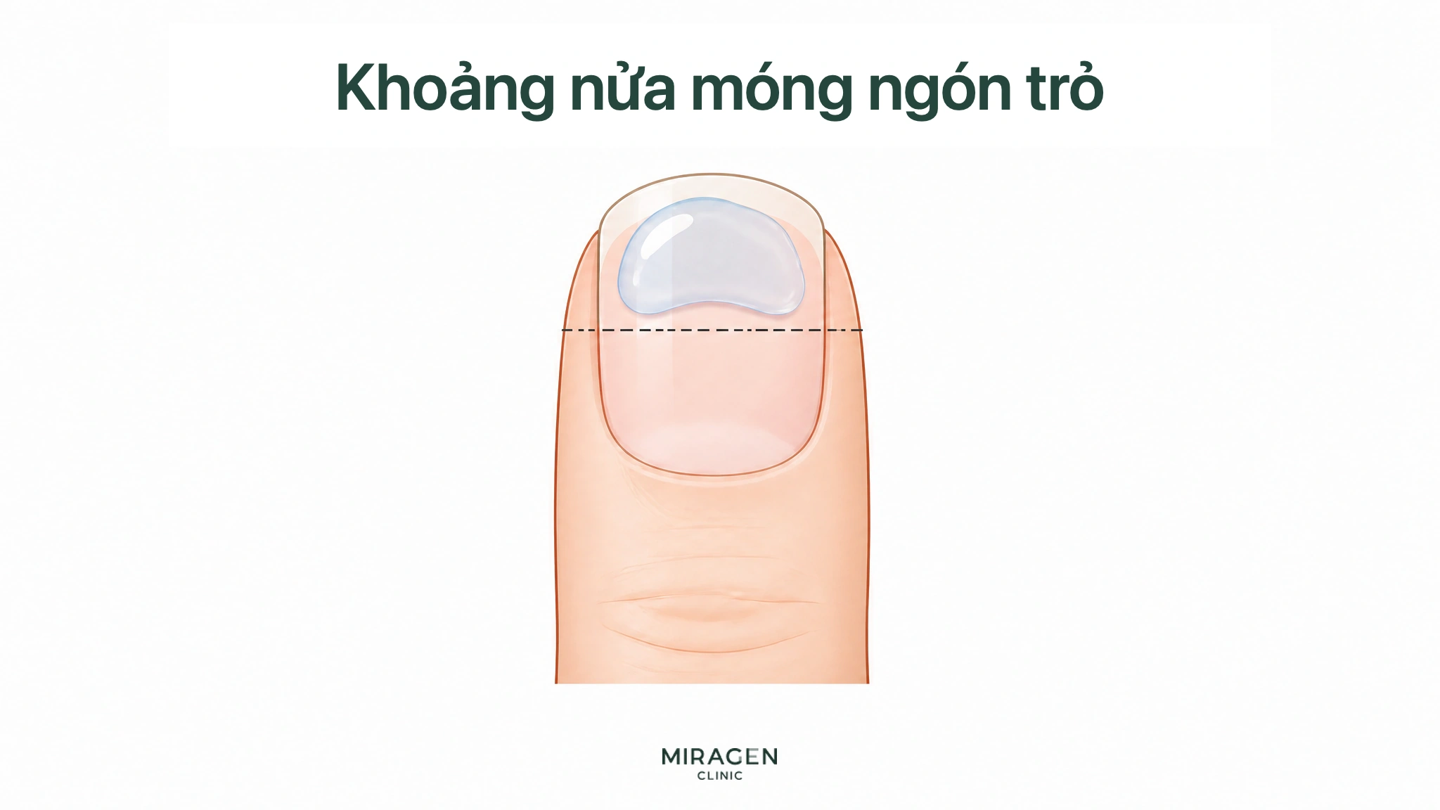 Hình lượng gel trong suốt bằng nửa phần trên móng ngón trỏ, có đường chấm đánh dấu liều khởi đầu khi trộn Differin với kem dưỡng