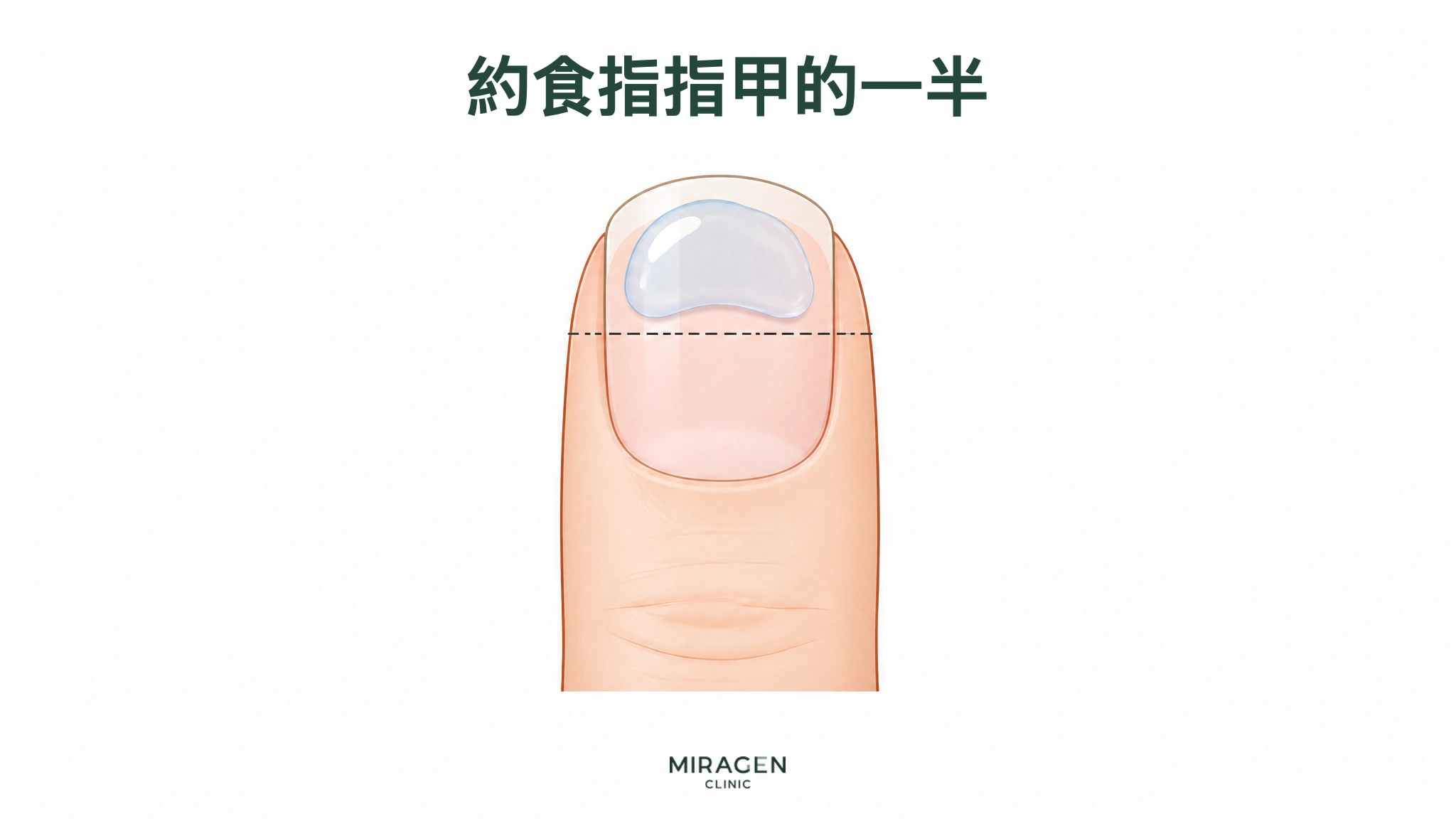 圖示在食指指甲上半部放置相應量的透明凝膠,並用虛線標示用量標準,用於說明與保濕劑混合時Differin凝膠的起始用量