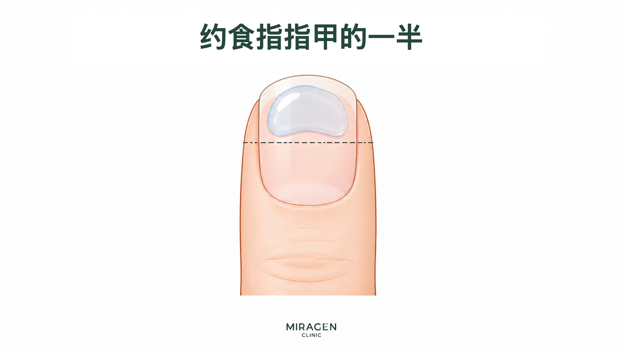 图示在食指指甲上半部放置相应量的透明凝胶，并用虚线标示用量标准，用于说明与保湿剂混合时达芙文凝胶的起始用量