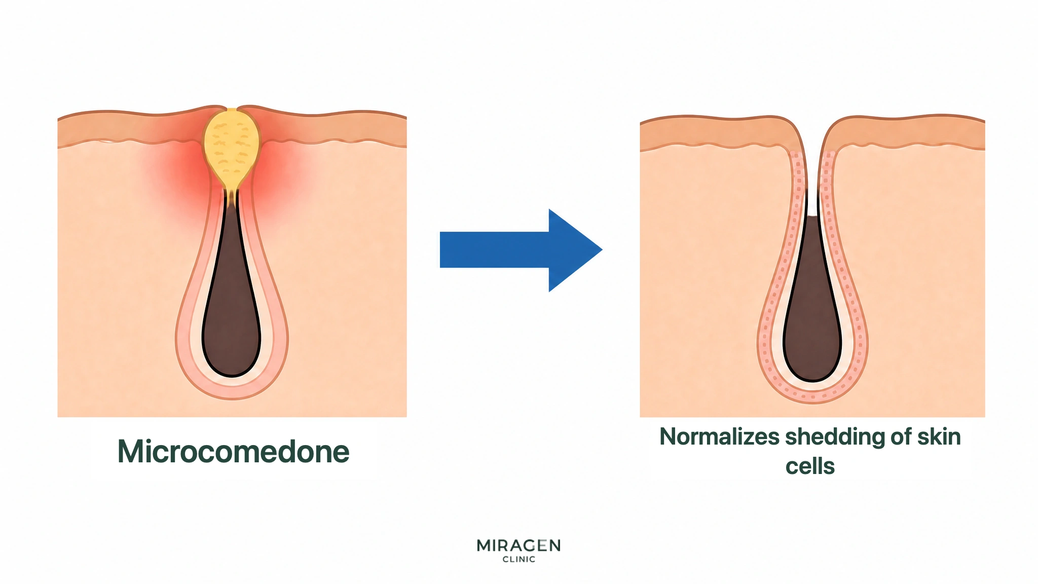 An illustration comparing skin cross-sections before and after treatment, showing microcomedones in pores clogged with dead skin cells being cleared by the action of Differin Gel and the pore opening up as skin cell shedding is normalized.