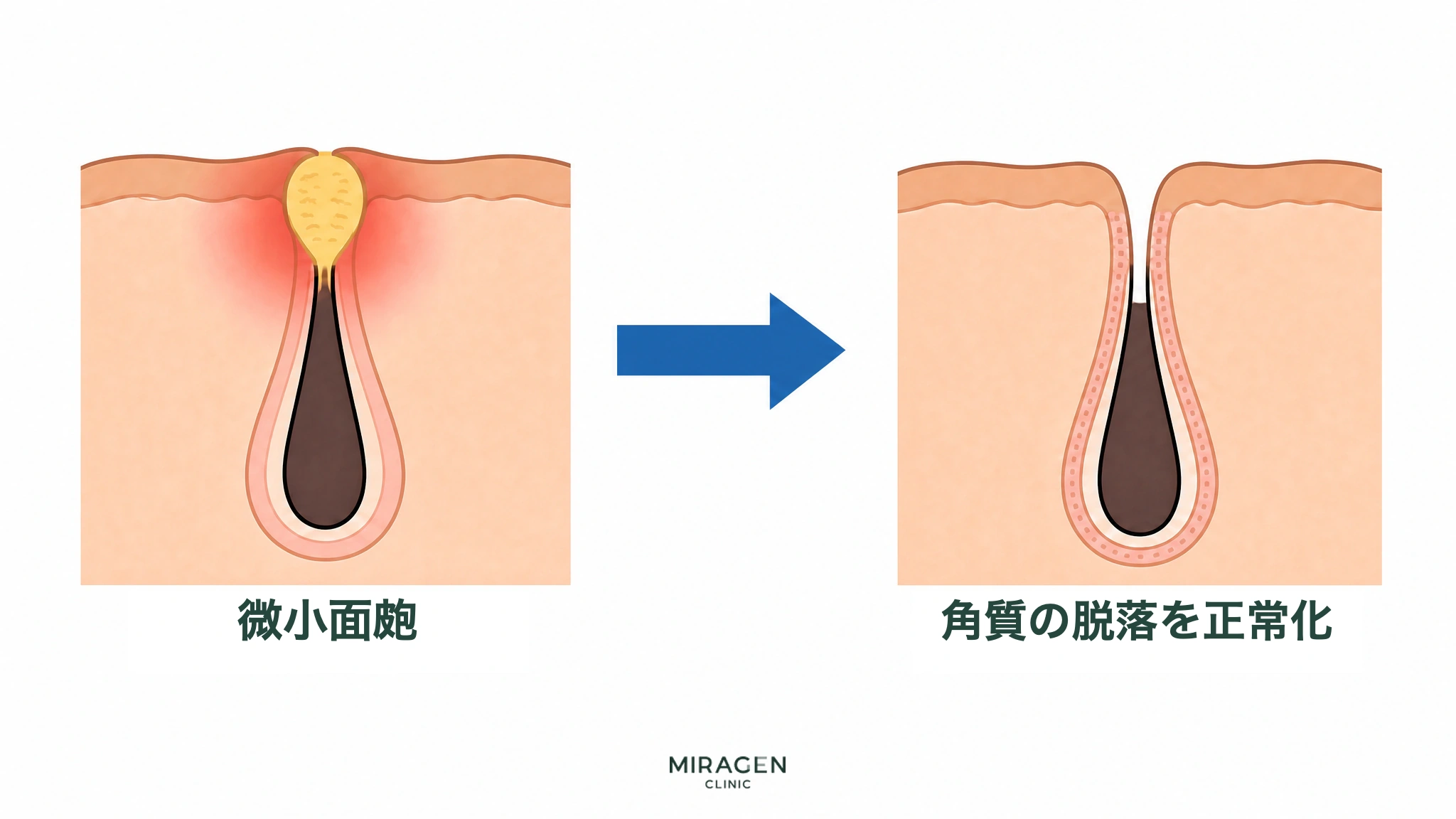 角質で詰まった毛穴の微小面皰がディフェリンゲルの作用により整理され、毛穴開口部が開いて角質脱落が正常化する変化を前後の皮膚断面で比較して示す図です。
