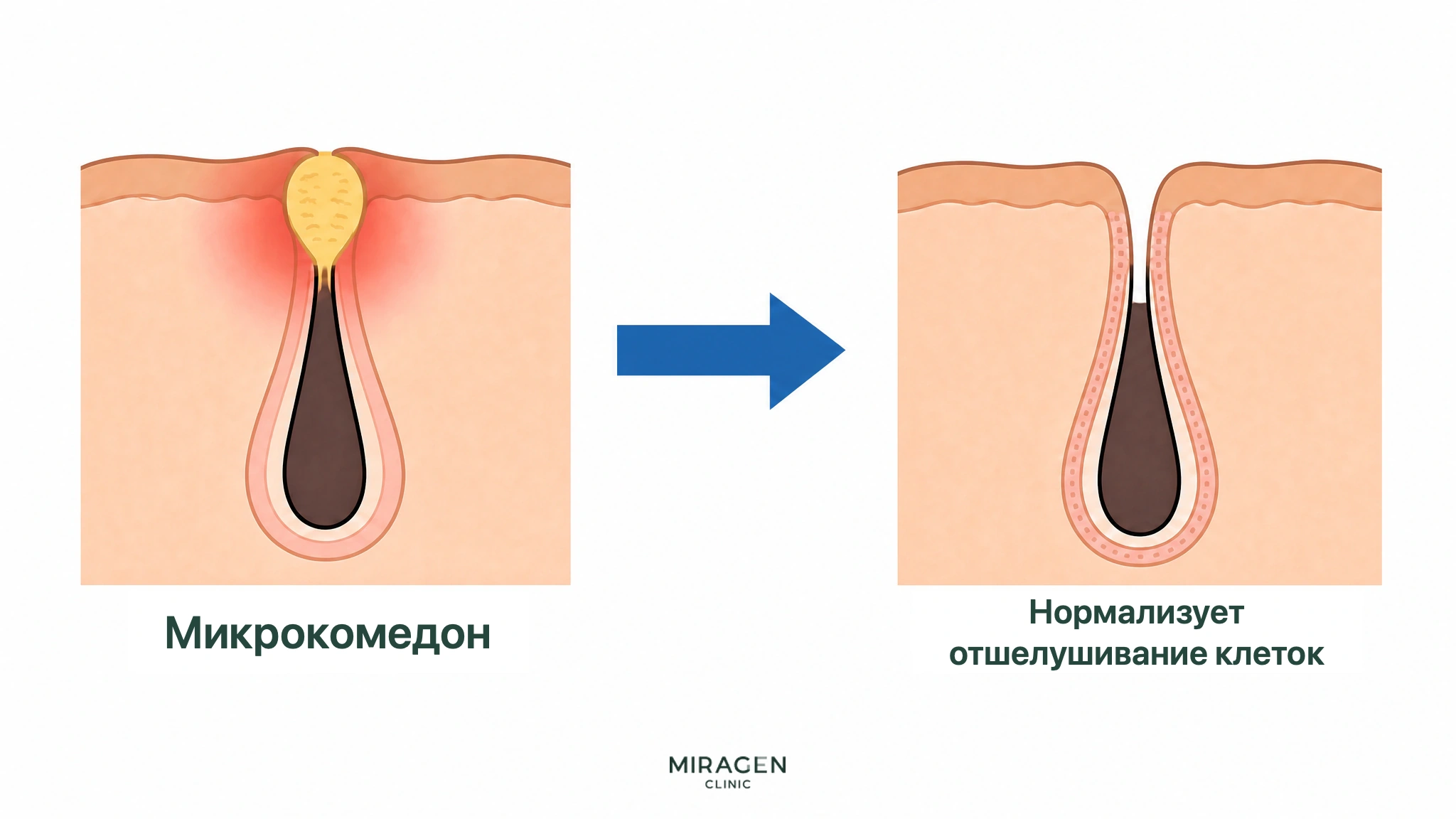 Разрез кожи до и после Дифферина показывает уменьшение микрокомедона, открытие поры и нормализацию отшелушивания роговых клеток