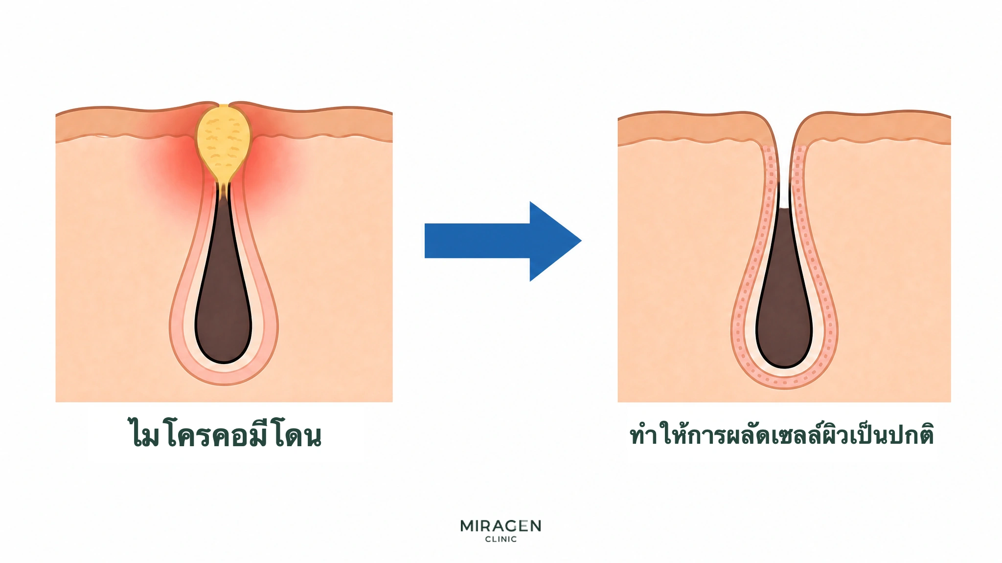ภาพตัดขวางผิวเปรียบเทียบรูขุมขนที่อุดตันด้วยหัวสิวขนาดเล็กกับหลังดิฟเฟอรินเจลช่วยให้เซลล์ผิวหลุดตามปกติและปากรูขุมขนเปิด